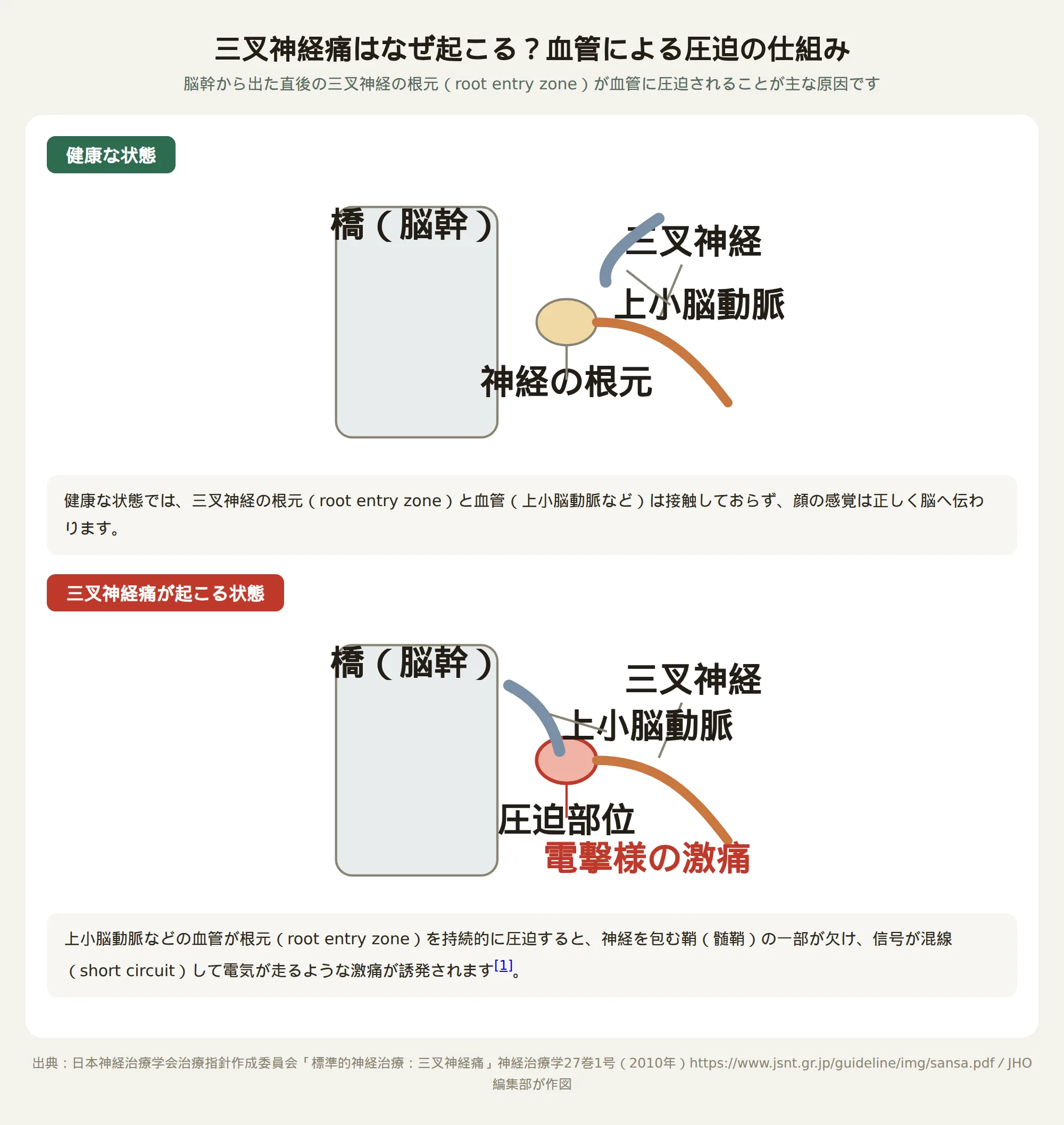 三叉神経痛の原因となる血管による神経圧迫の仕組みを示す図解。健康な状態と、上小脳動脈が三叉神経の根元を圧迫している状態を比較