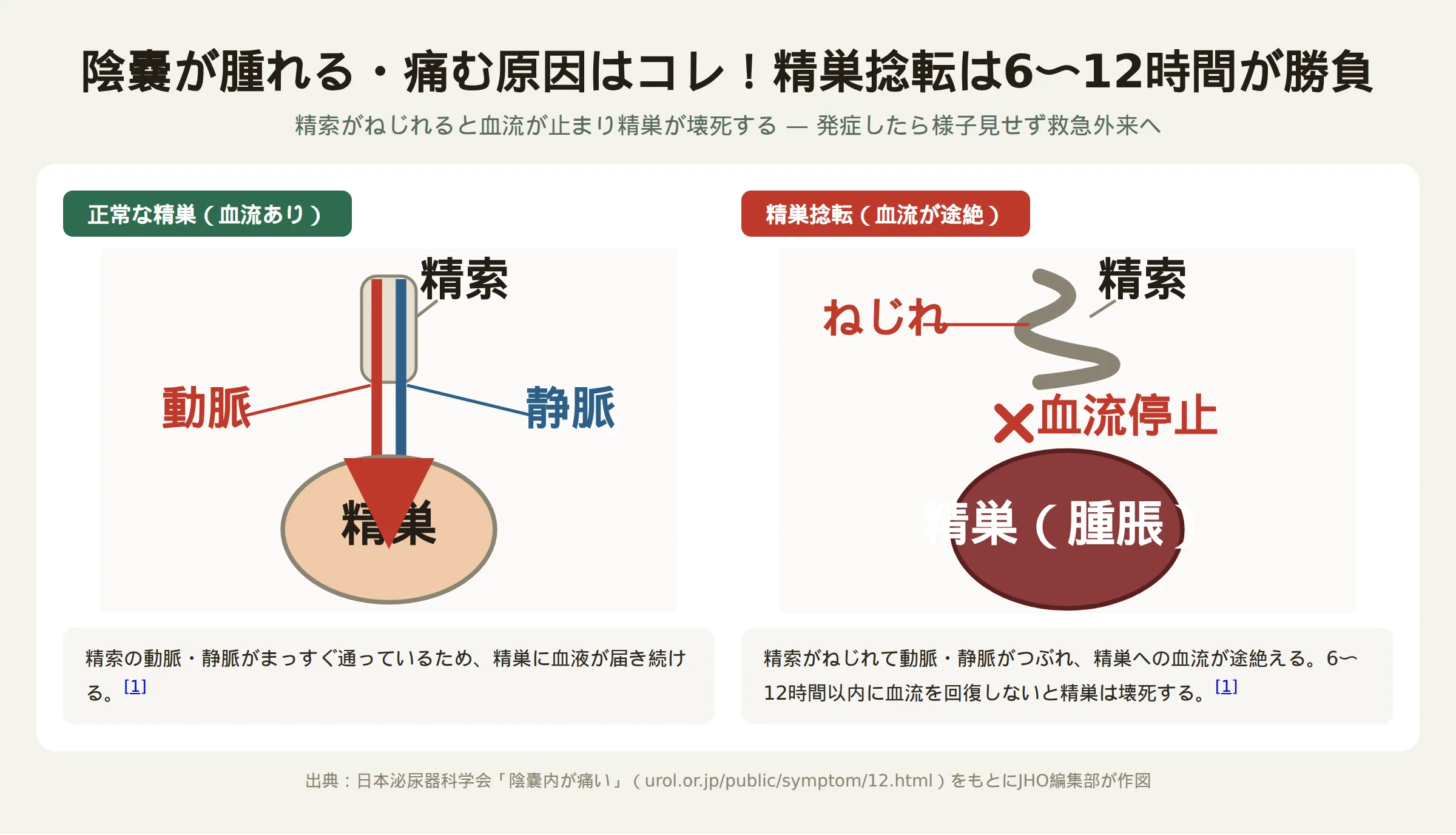 精巣捻転の仕組み。正常な精巣は精索がまっすぐで動脈と静脈の血流が保たれているが、精巣捻転では精索がねじれて血管がつぶれ血流が止まり、精巣が腫れて赤黒く変色する
