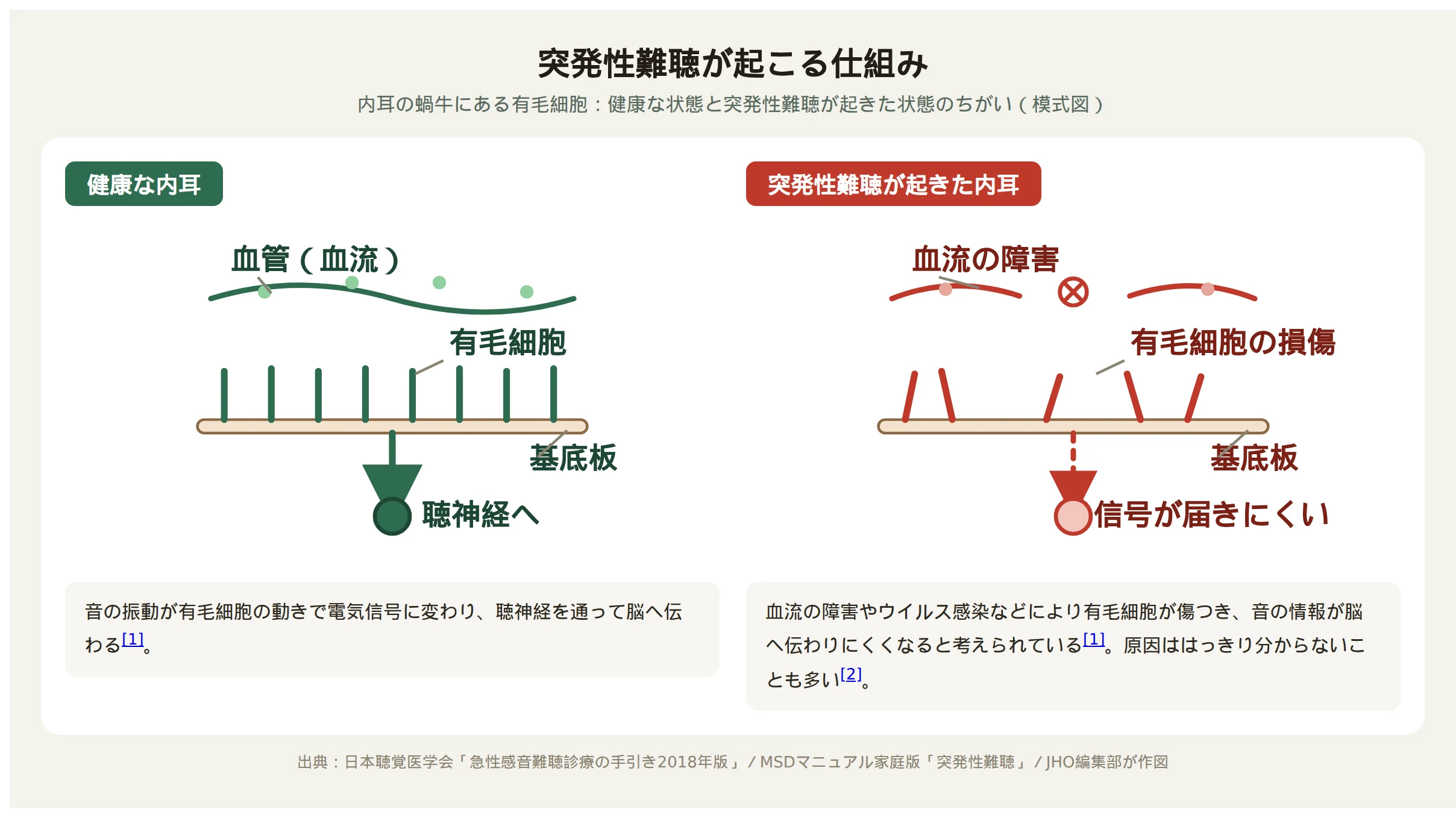 内耳の蝸牛にある有毛細胞を、健康な状態と突発性難聴が起きた状態で比較した模式図。健康な状態では蝸牛内の血流が保たれ有毛細胞が規則正しく並び音の振動を電気信号に変えて聴神経へ伝えているが、突発性難聴の状態では血流の障害や有毛細胞の損傷によって音の情報が脳に届きにくくなっている様子を示す
