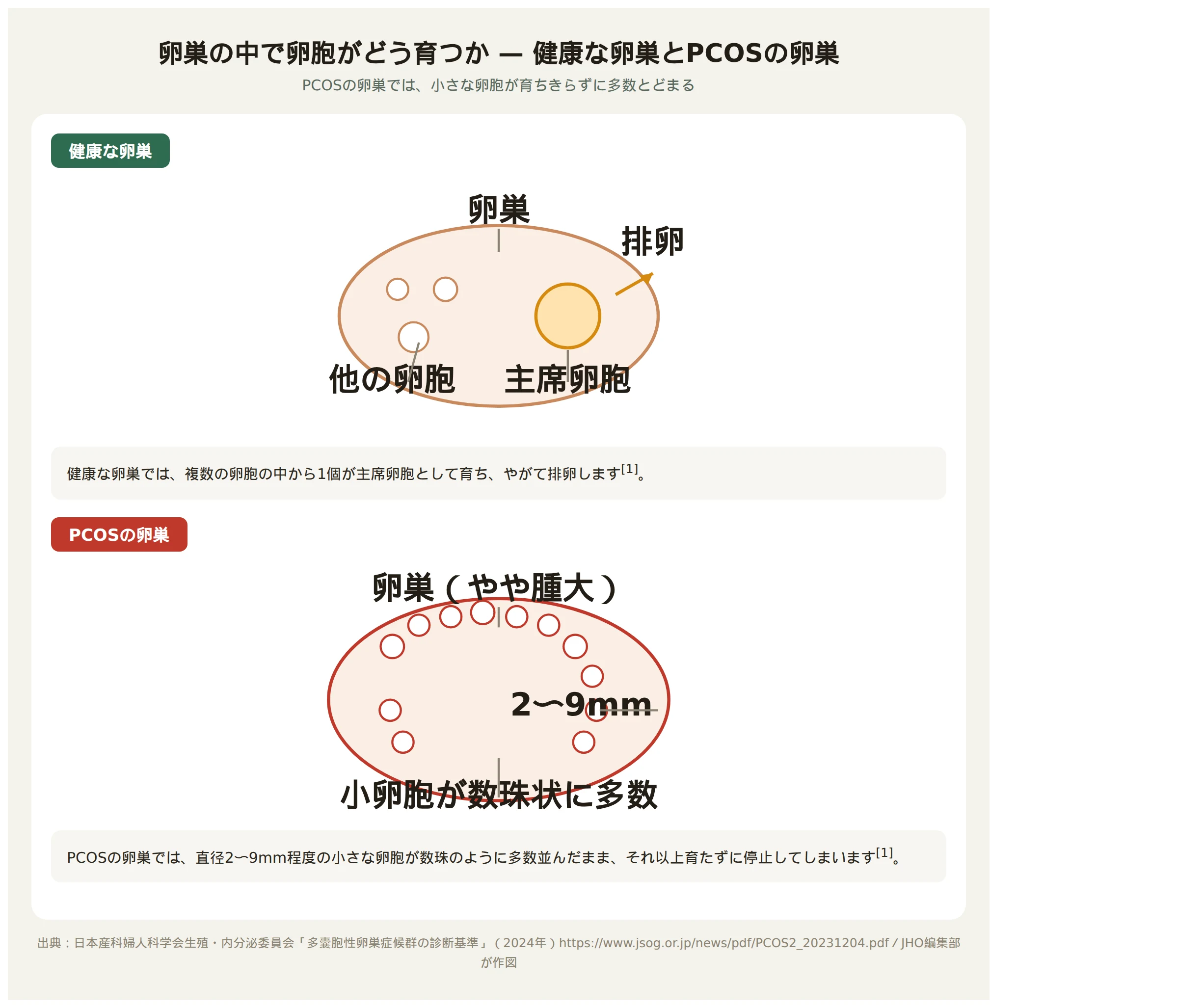 卵巣の中の卵胞の様子を示す図。健康な卵巣では少数の卵胞から1個が育って排卵するのに対し、PCOSの卵巣では小さな卵胞が多数並んだまま育ちきらず停止している