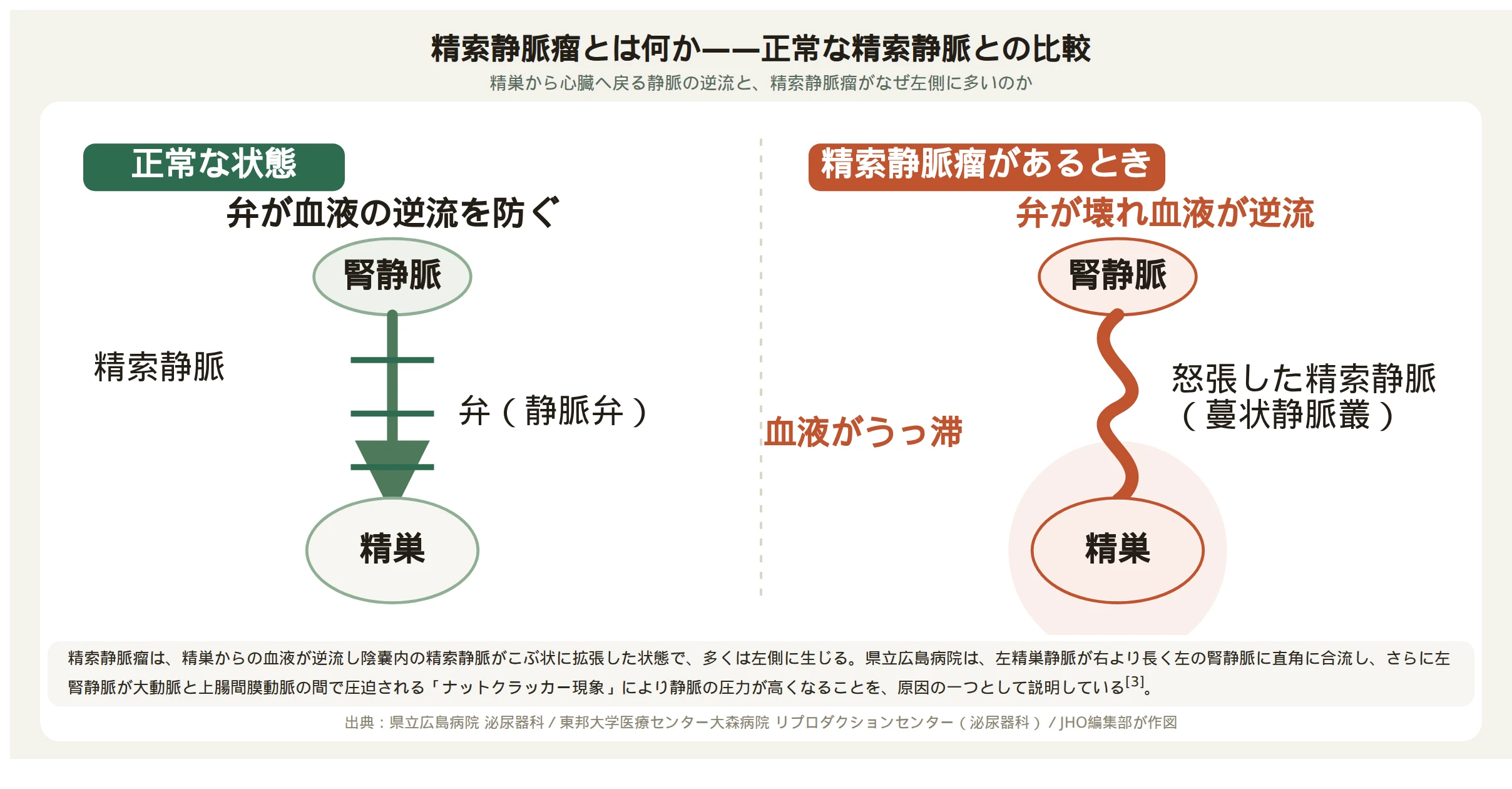 正常な精索静脈と精索静脈瘤がある状態を比較する図。左側は弁が逆流を防ぐ正常な精索静脈と精巣、右側は弁が壊れて血液が逆流し怒張した精索静脈（蔓状静脈叢）と、うっ血の影響を受ける精巣を示す。