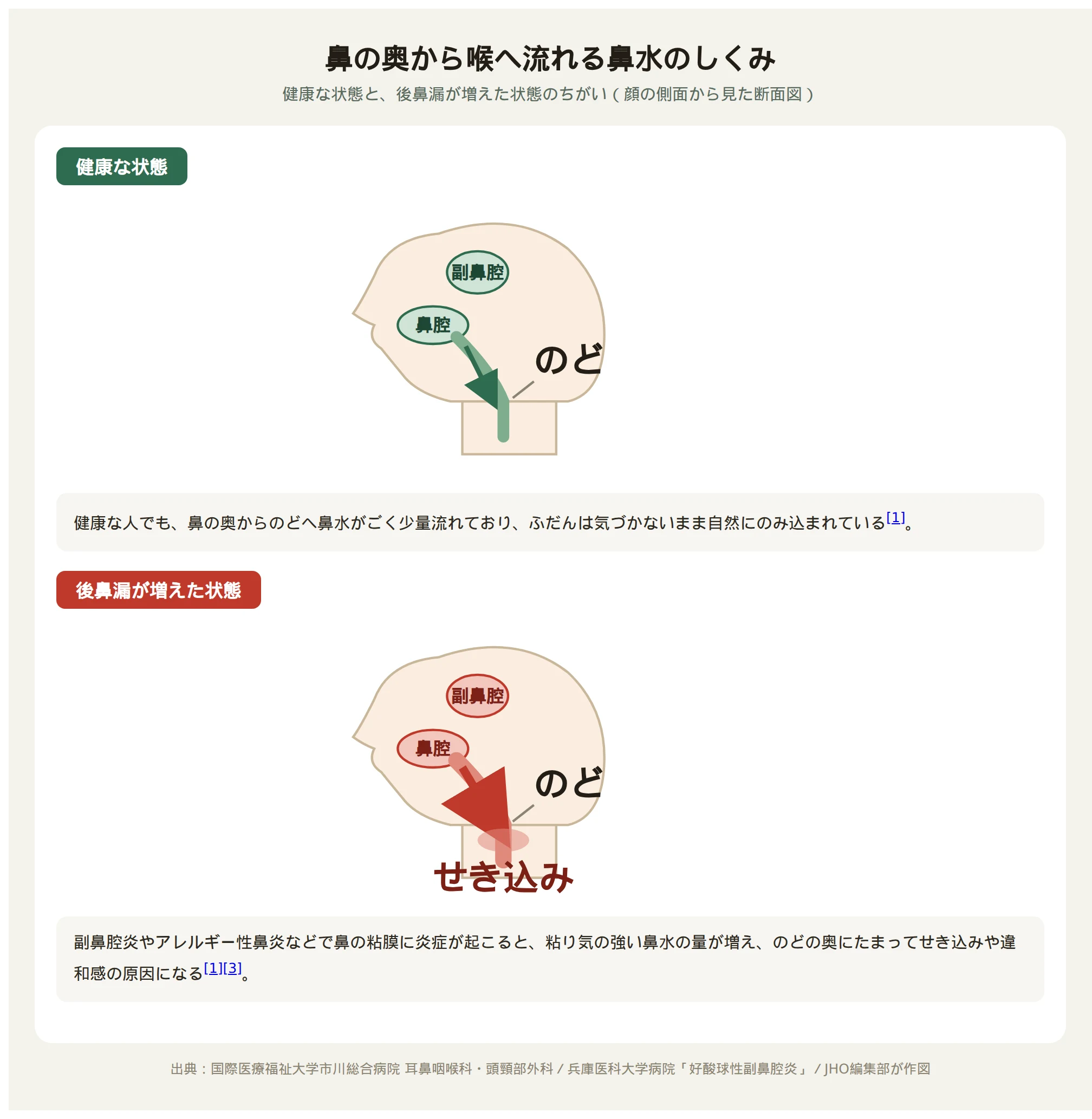 鼻の奥から喉へ流れる鼻水のしくみ。健康な状態と後鼻漏が増えた状態を比較した断面図