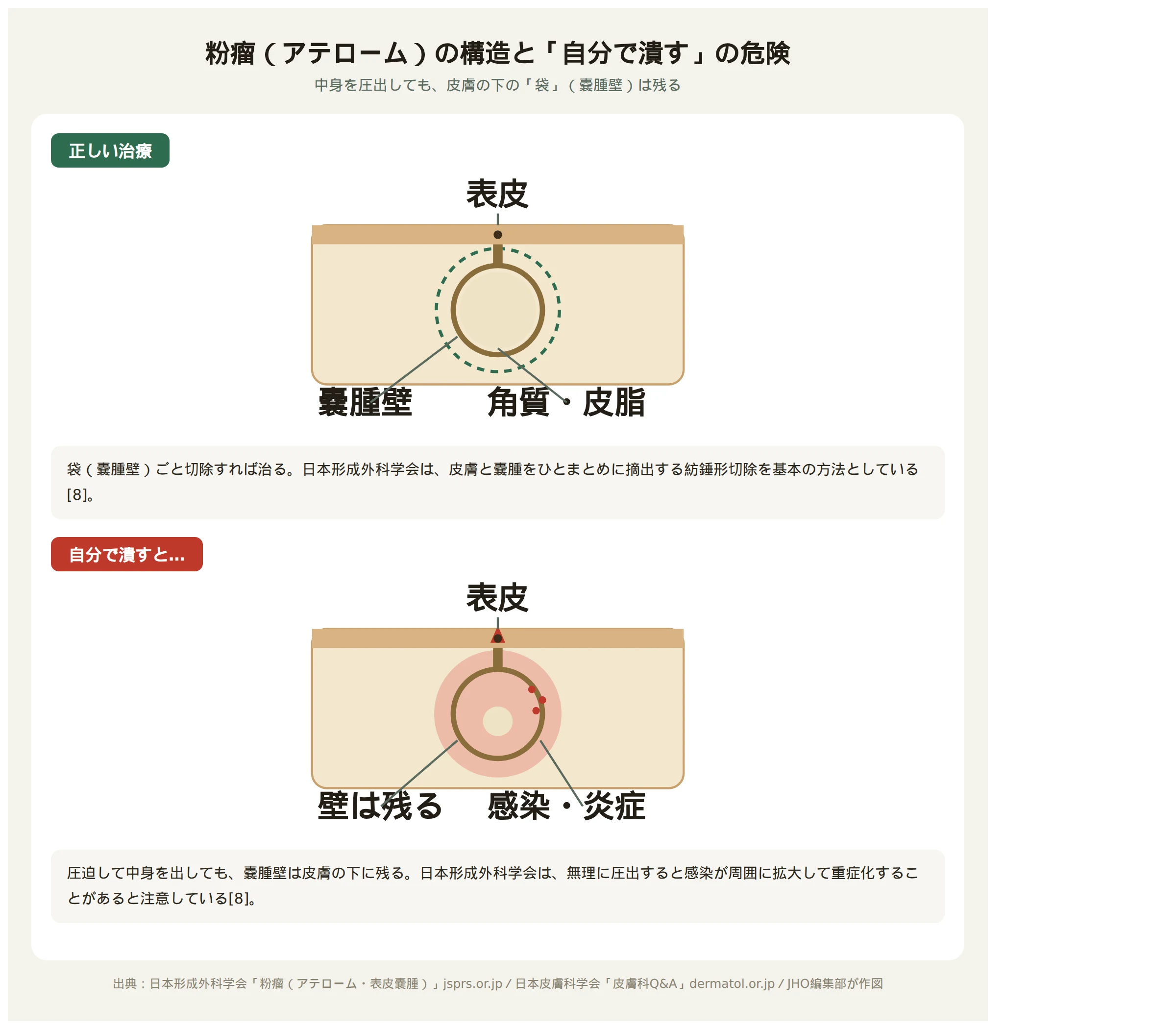 粉瘤の構造（嚢腫壁と角質・皮脂）と、自分で潰した場合に嚢腫壁が皮下に残る仕組みを示す図