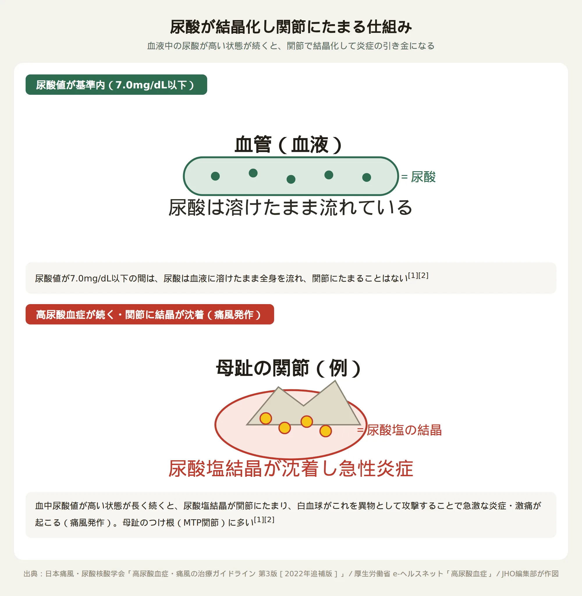 尿酸値が基準内では血液に溶けたまま流れているが、高尿酸血症が続くと関節に尿酸塩結晶が沈着し急性炎症（痛風発作）が起こる仕組みを示した図