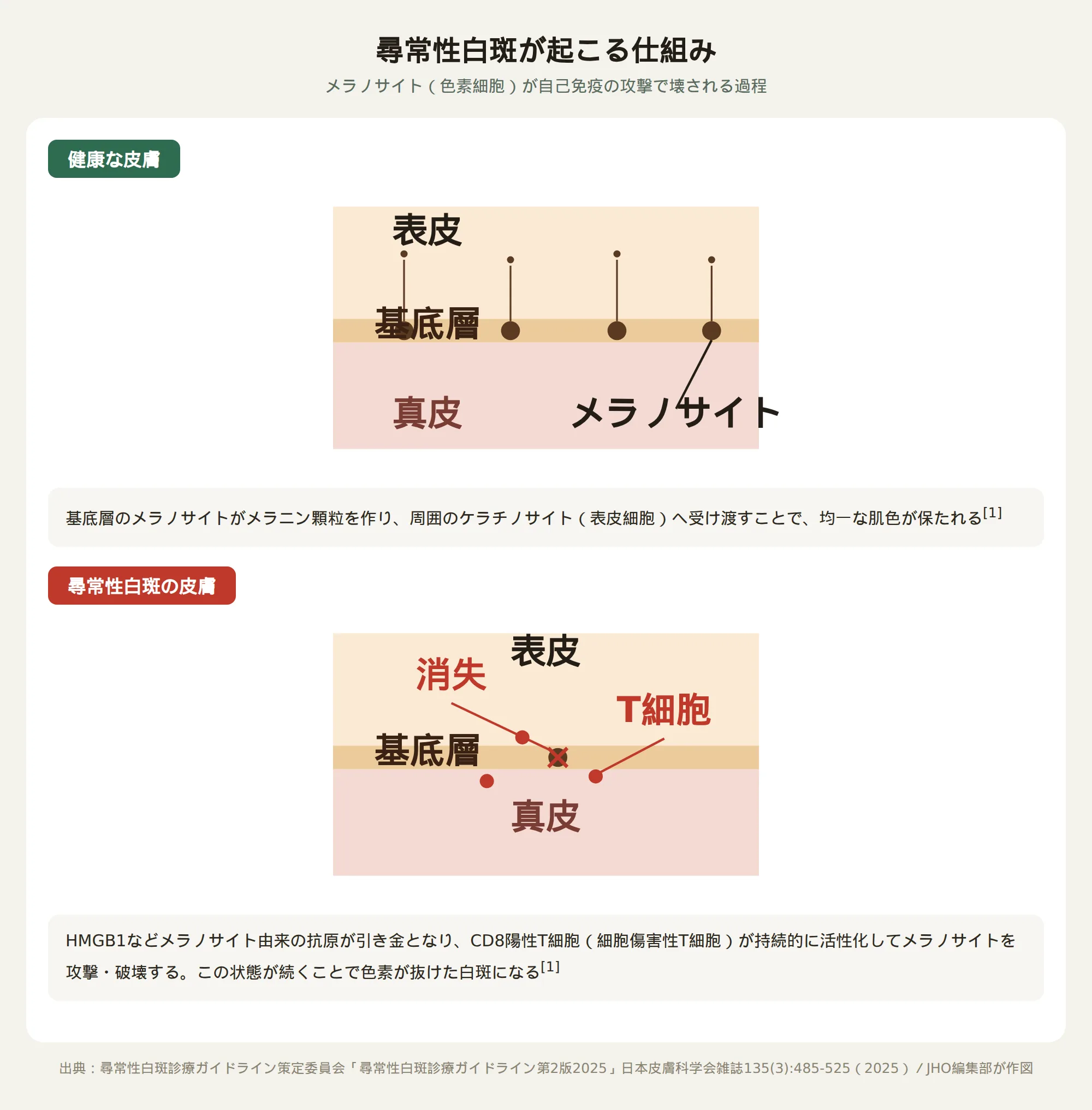 尋常性白斑の発症メカニズム図：健康な皮膚ではメラノサイトがメラニンを周囲の細胞へ受け渡すが、白斑の皮膚ではCD8陽性T細胞がメラノサイトを攻撃・破壊する比較図