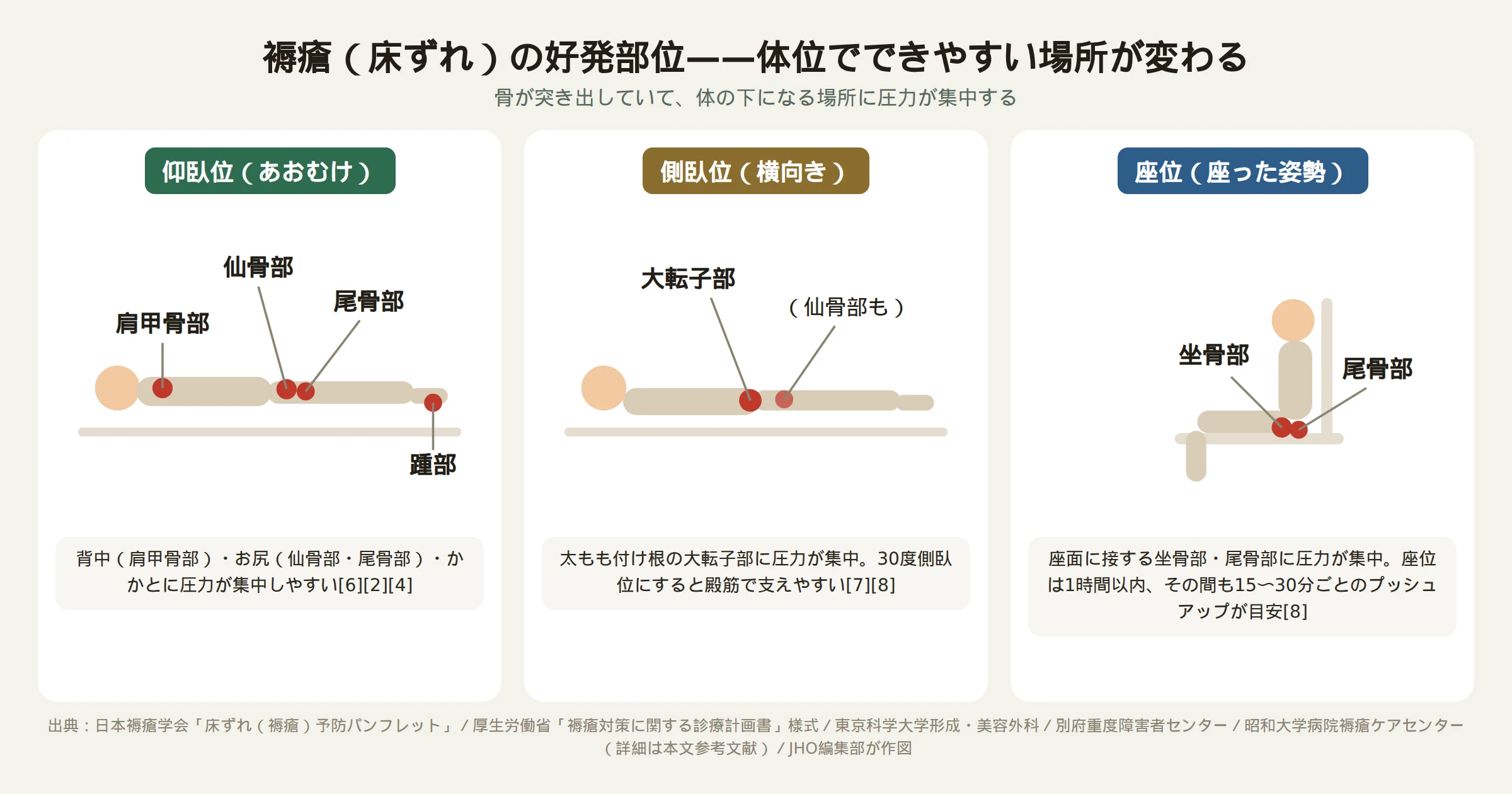 床ずれの好発部位を示す図。仰臥位（あおむけ）では肩甲骨部・仙骨部・尾骨部・踵部、側臥位（横向き）では大転子部、座位（座った姿勢）では坐骨部・尾骨部に圧力が集中しやすいことを、簡略化した人体シルエットと丸印で示している