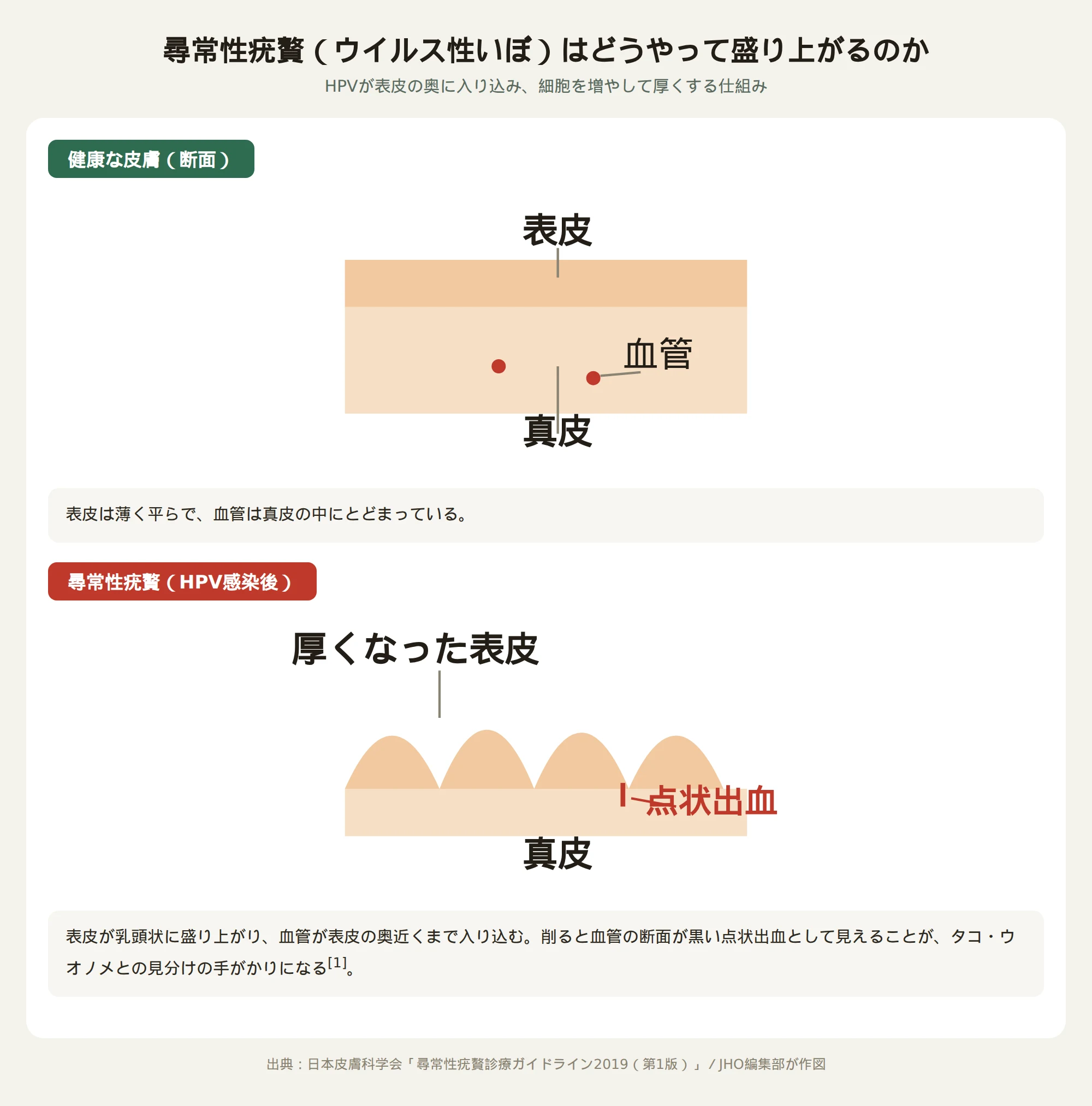 尋常性疣贅の断面図。健康な皮膚とHPV感染後の皮膚を比較し、表皮が厚くなり血管が表皮近くまで入り込む様子を示す