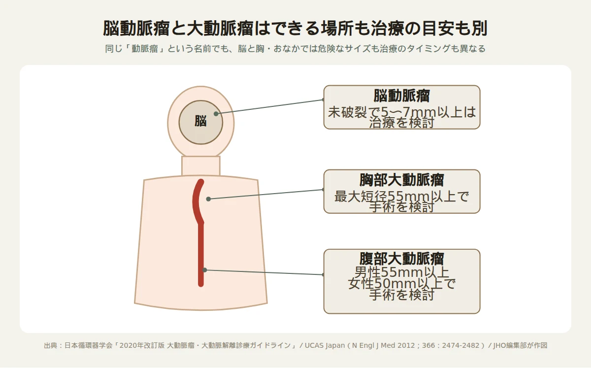 脳動脈瘤と大動脈瘤ができる場所と治療を検討する目安サイズを対比した図。脳には脳動脈瘤（未破裂で5〜7mm以上は治療検討）、胸部には胸部大動脈瘤（最大短径55mm以上で手術検討）、腹部には腹部大動脈瘤（男性55mm以上・女性50mm以上で手術検討）の位置と基準を示す