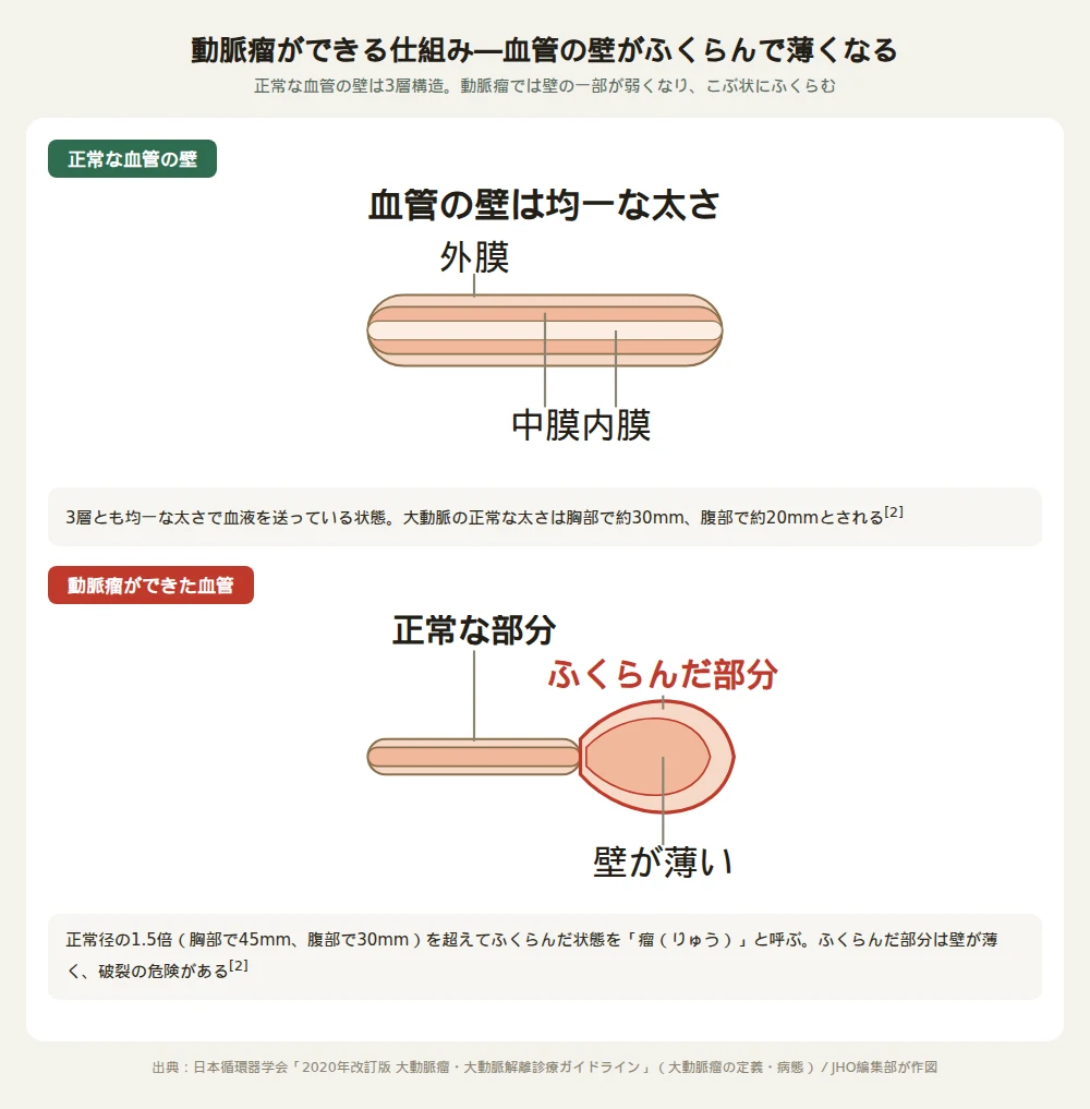 正常な血管の壁（内膜・中膜・外膜の3層構造が均一）と、動脈瘤ができた血管（壁の一部が薄くこぶ状にふくらんだ状態）を比較した断面図