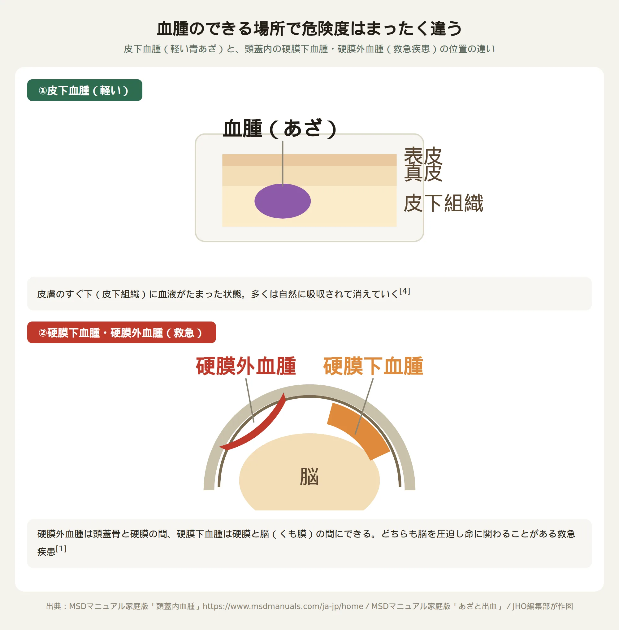 皮下血腫と硬膜下血腫・硬膜外血腫の位置の違いを示す図。硬膜外血腫は頭蓋骨と硬膜の間、硬膜下血腫は硬膜と脳の間にできることを示している
