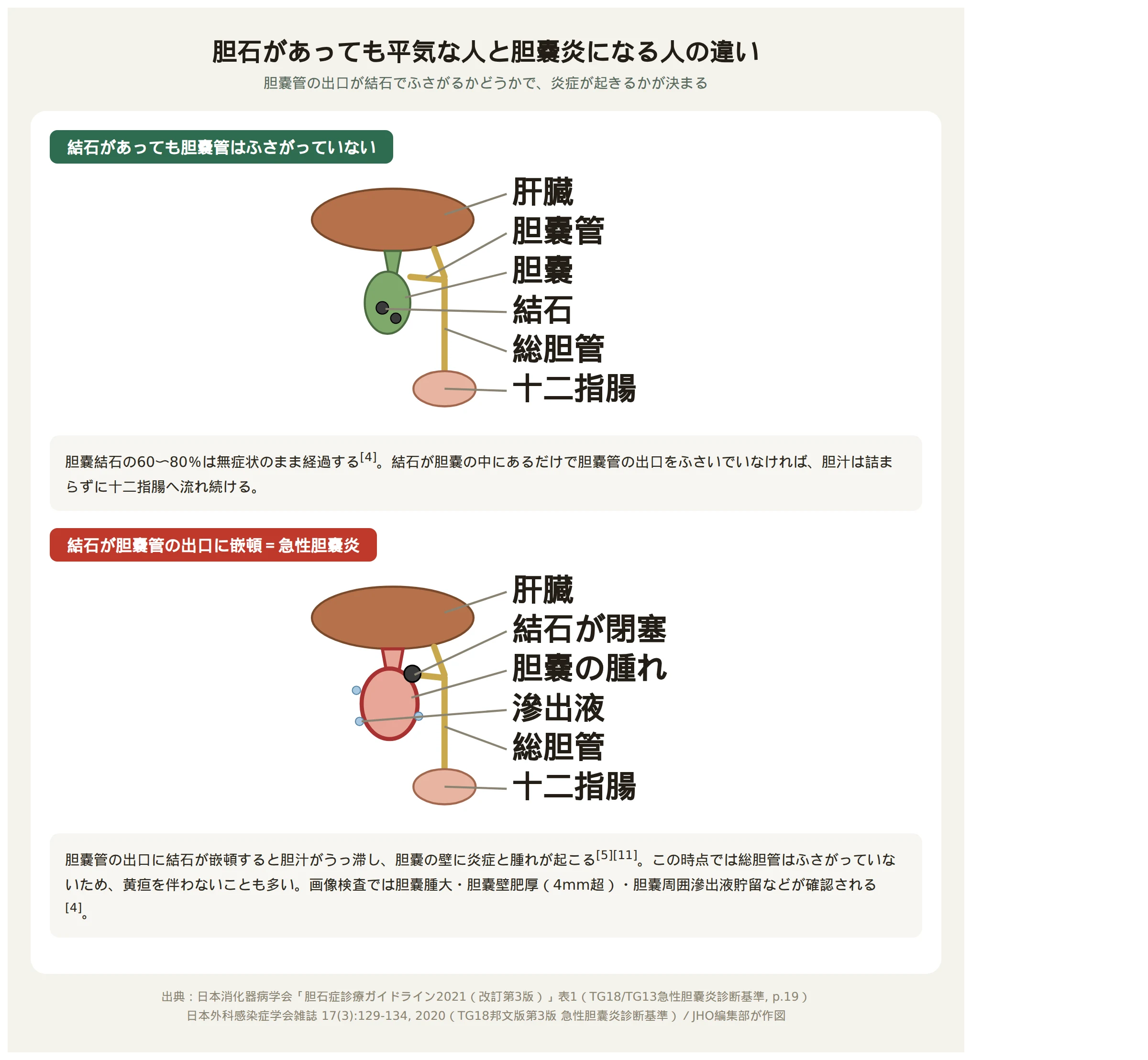 胆石があっても胆嚢管がふさがっていなければ無症状で経過し、胆嚢管の出口に結石が嵌頓すると急性胆嚢炎になることを示す比較図