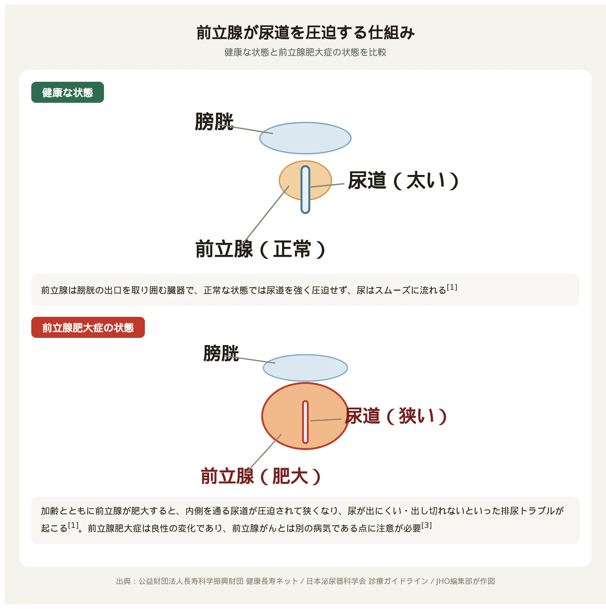 前立腺が尿道を圧迫する仕組みの図解。健康な状態では尿道が太く保たれているが、前立腺肥大症の状態では前立腺が大きくなり尿道が狭く圧迫される