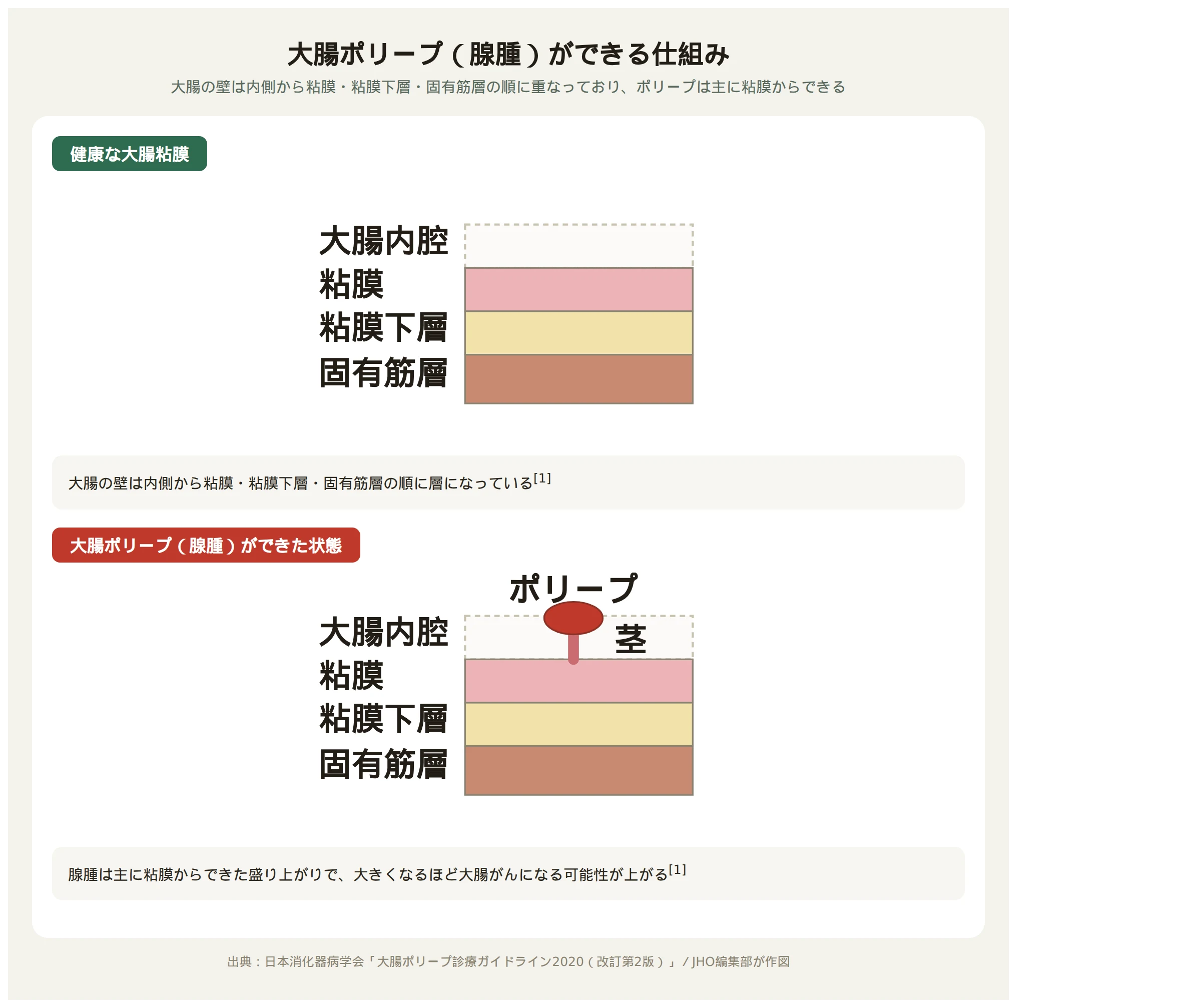 大腸の壁の断面図。健康な粘膜と、粘膜からポリープ（腺腫）が盛り上がった状態を比較した図