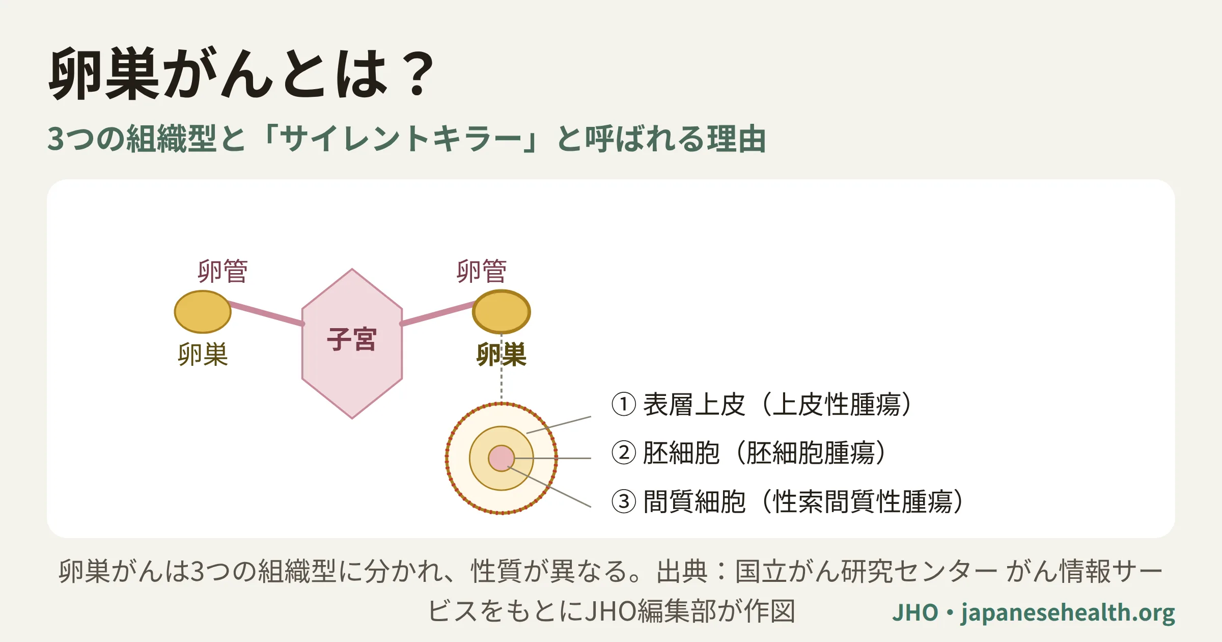 卵巣の位置と上皮性・胚細胞性・性索間質性の3つの組織型を示す卵巣がんの解説図