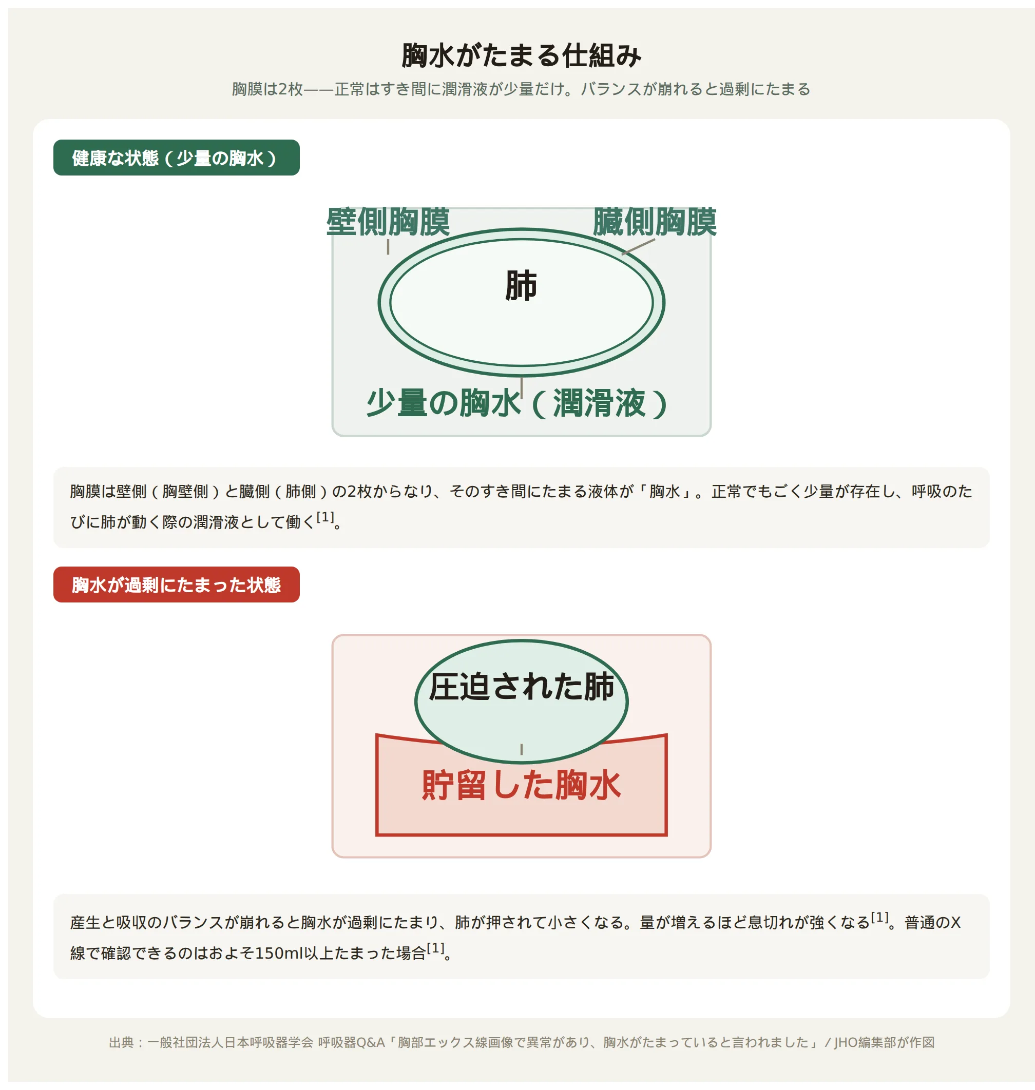 胸水がたまる仕組み：健康な状態では胸膜のすき間に少量の胸水があるだけだが、産生と吸収のバランスが崩れると過剰にたまり肺が圧迫される