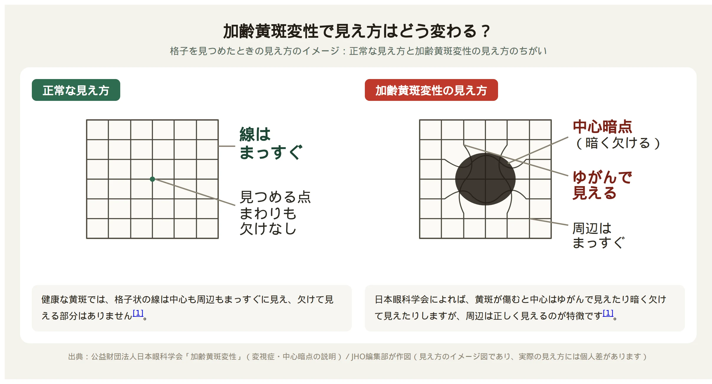 加齢黄斑変性による見え方の変化をあらわす図。左のパネルは正常な見え方で格子状の線がまっすぐ見え、右のパネルは加齢黄斑変性の見え方で格子の中心がゆがみ、中心に暗く欠けた部分（中心暗点）がある