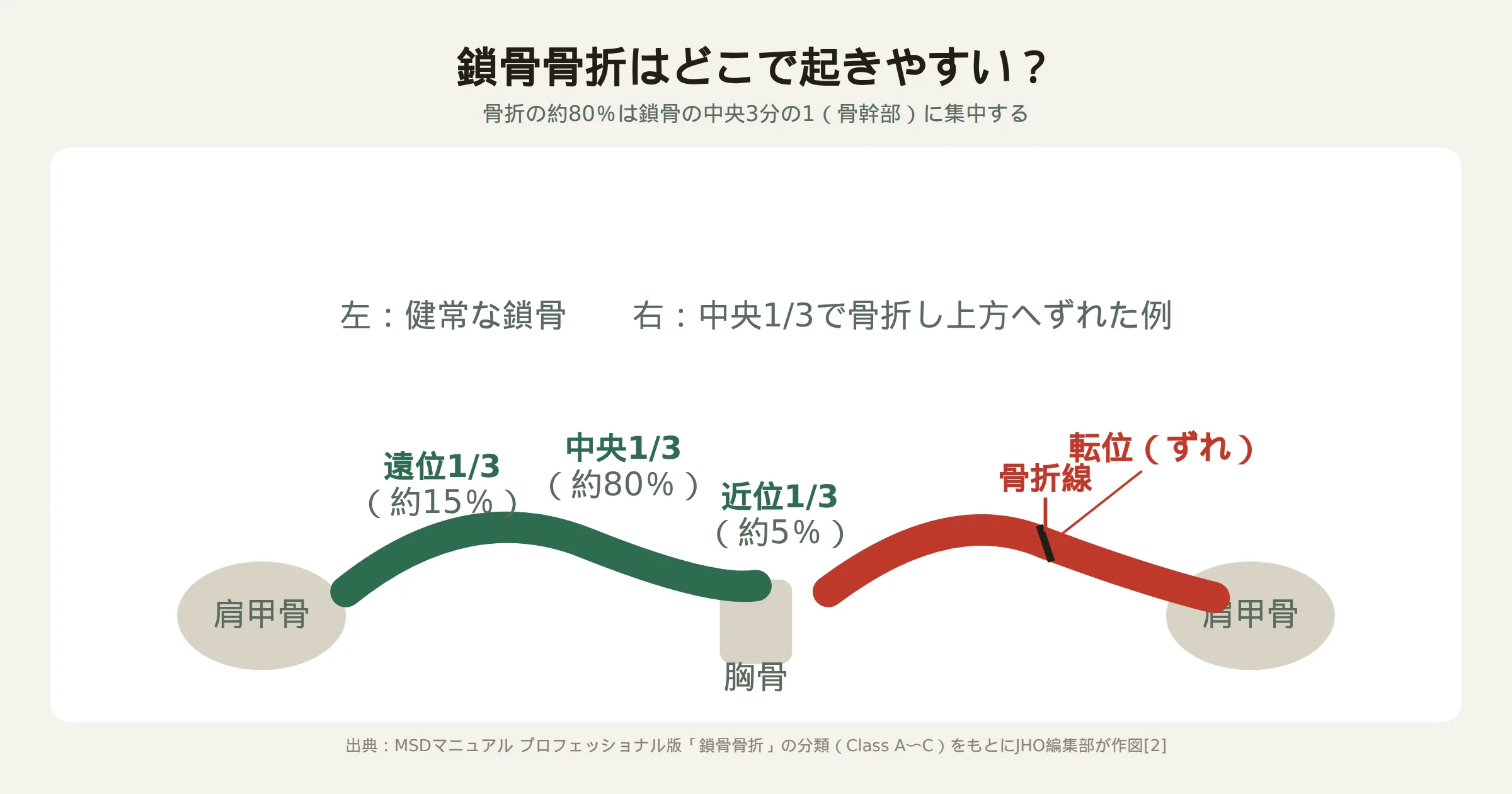鎖骨を近位3分の1・中央3分の1・遠位3分の1に分け、健常な鎖骨と中央3分の1で骨折してずれた鎖骨を比較した図。骨折の約80%が中央3分の1に集中することを示す