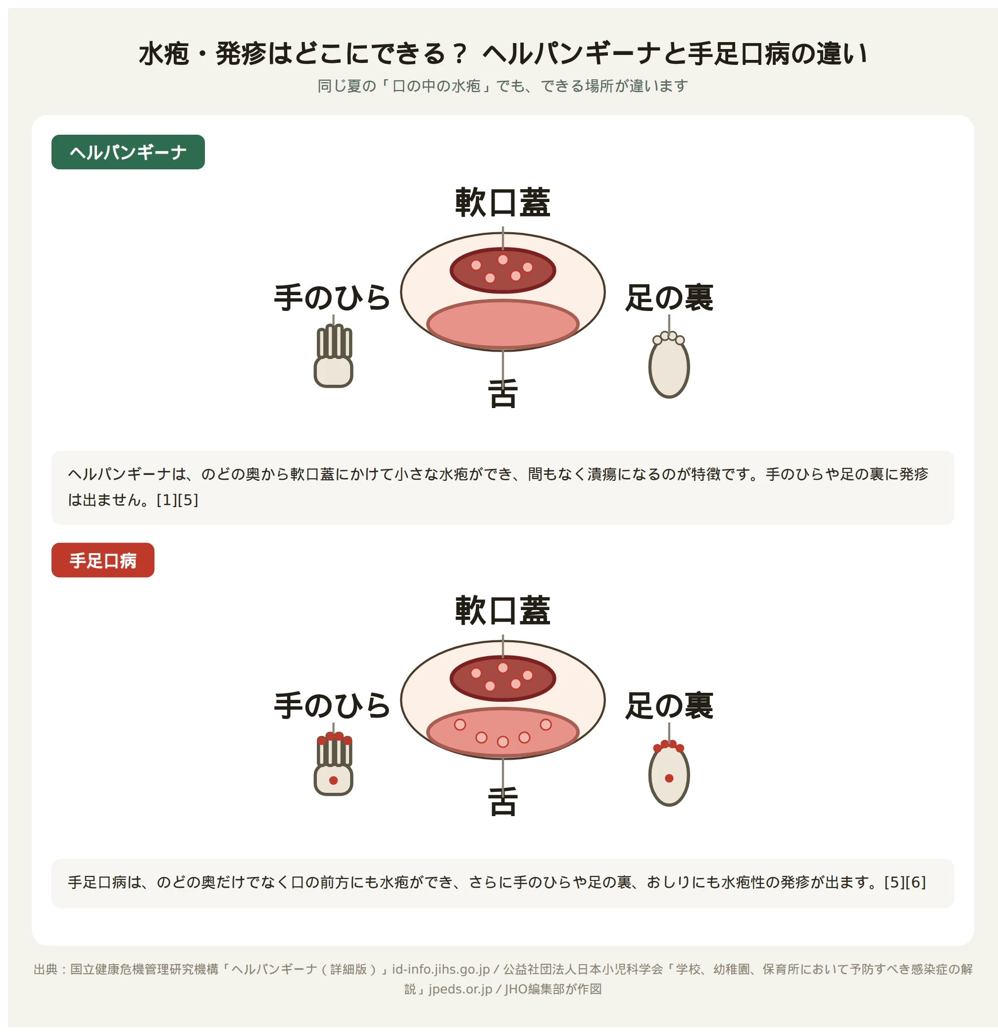 ヘルパンギーナと手足口病で水疱ができる場所の違いを示す図。ヘルパンギーナはのどの奥(軟口蓋)だけに水疱ができ、手足口病は口の前方と手のひら・足の裏にも水疱ができる