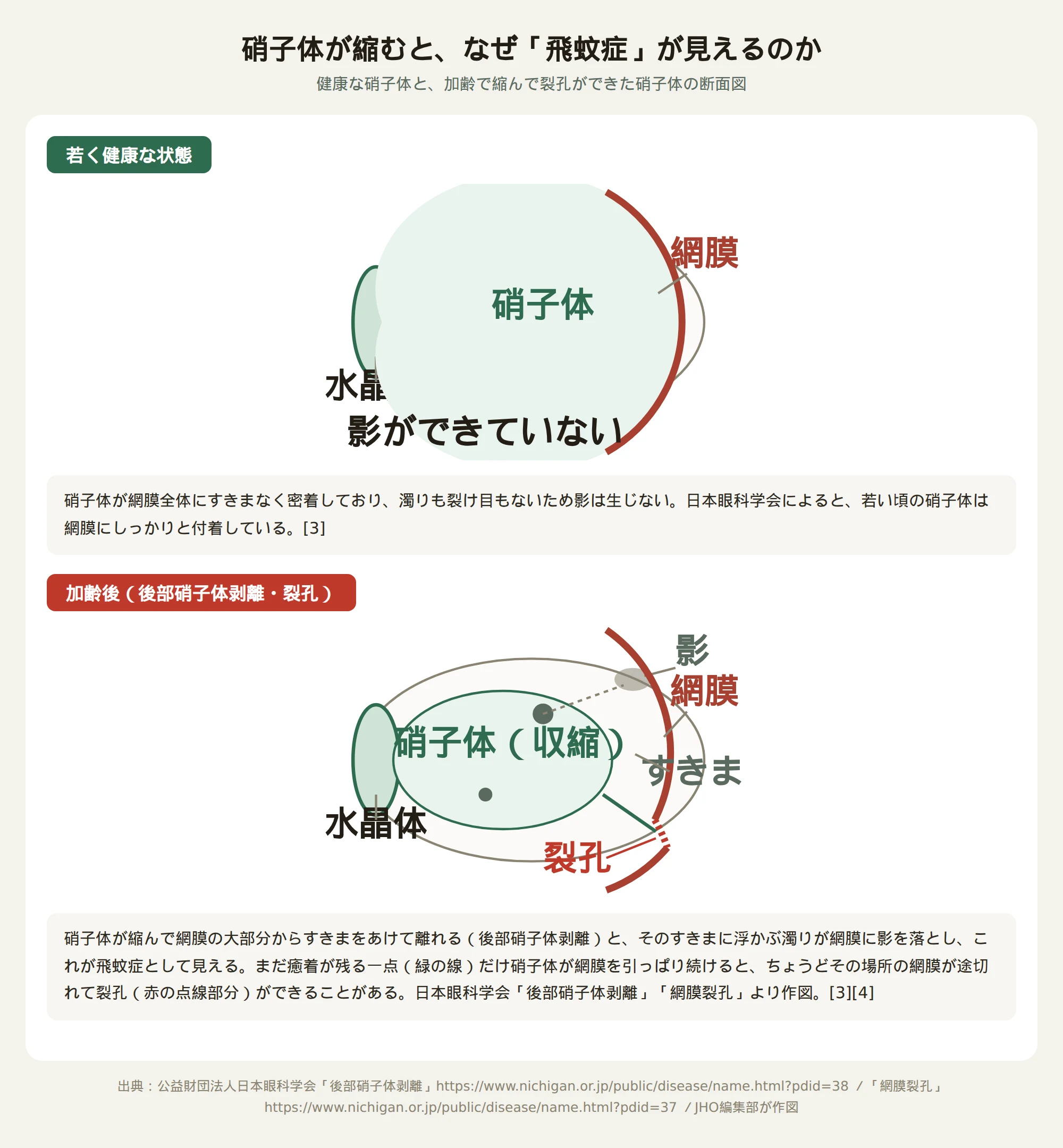 健康な硝子体（網膜にぴったり付着）と、加齢で縮んで網膜裂孔ができた硝子体の断面比較図