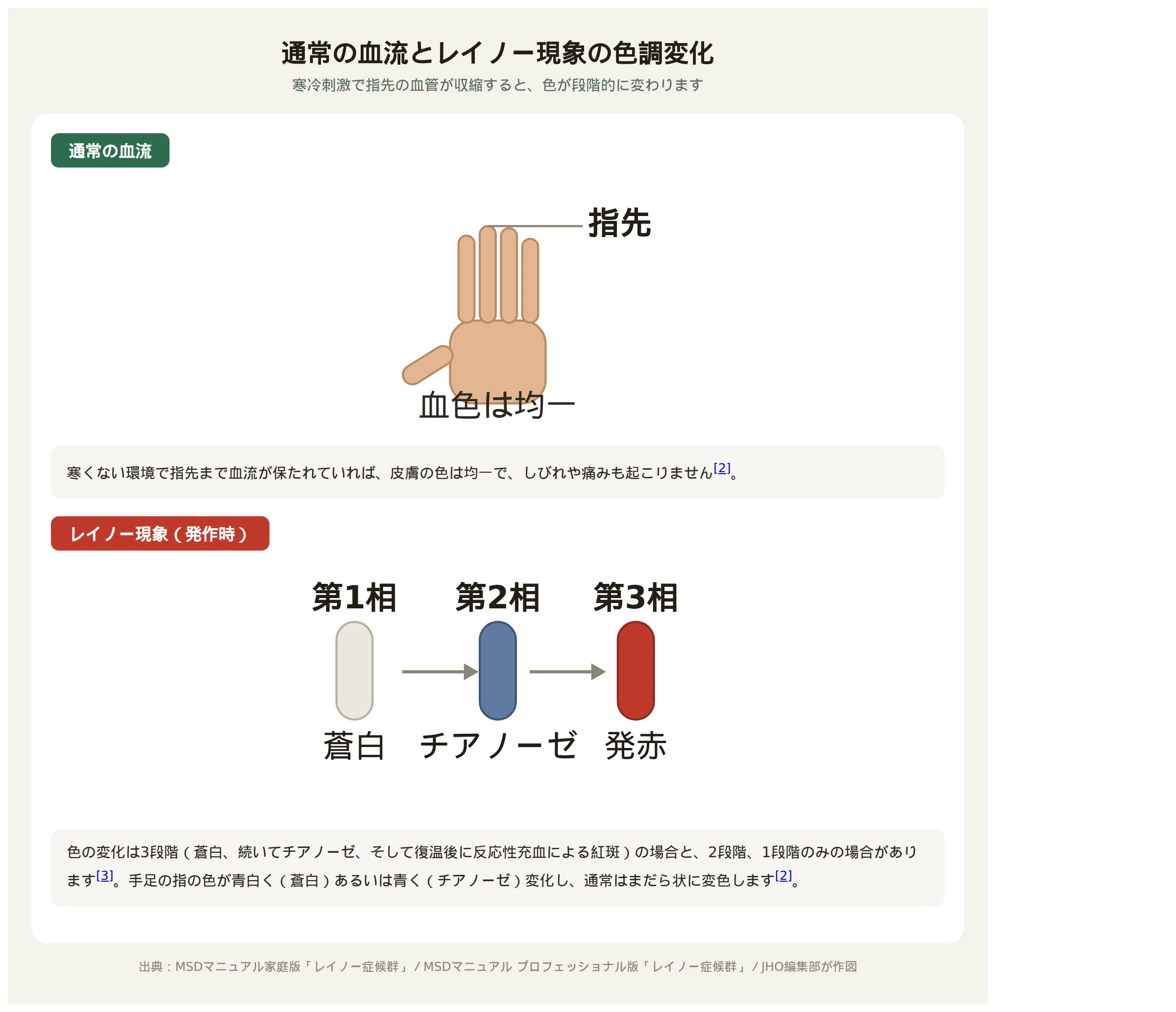 通常の血流とレイノー現象の三相性の色調変化（蒼白→チアノーゼ→発赤）を示す比較図