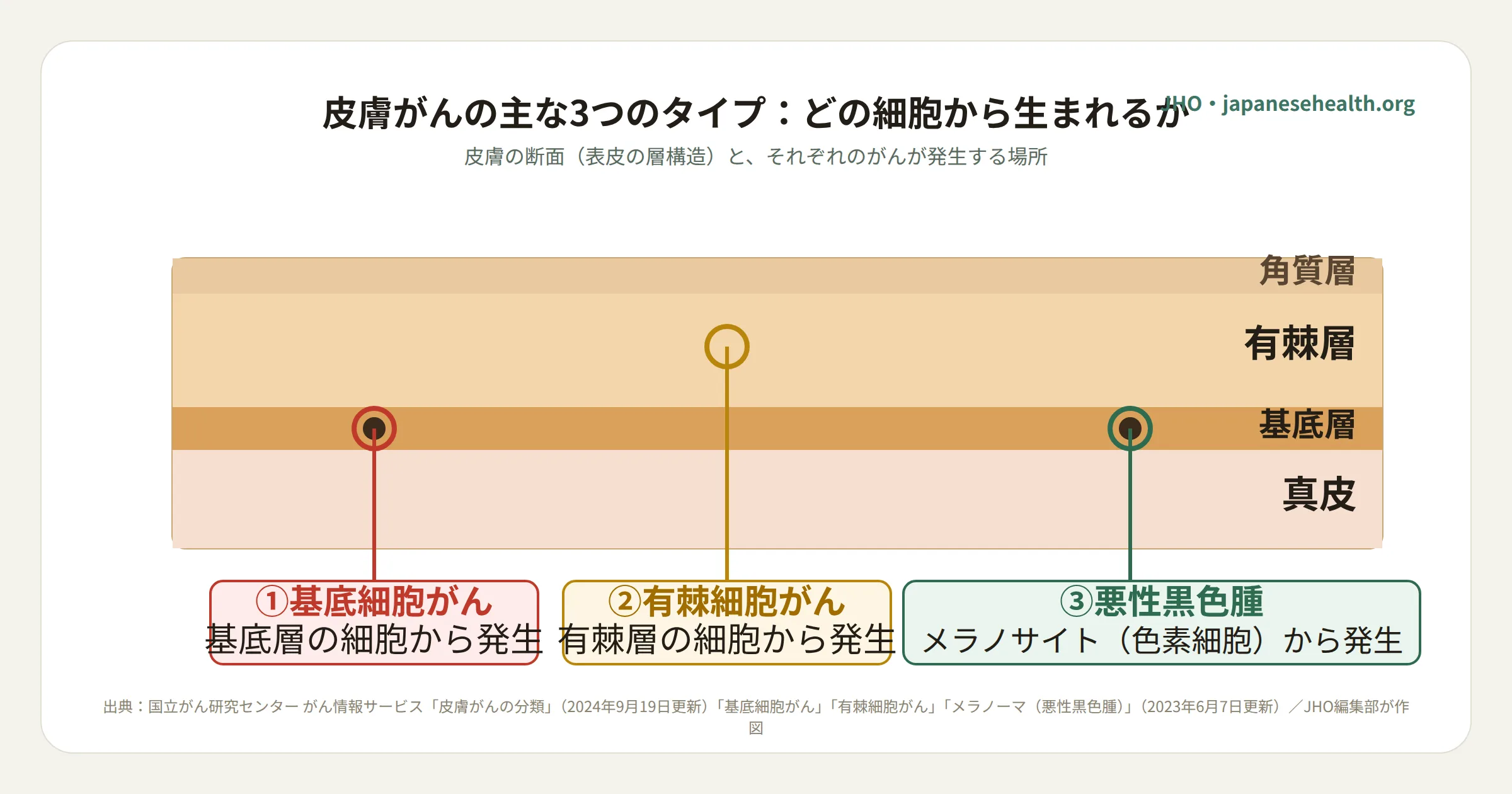 皮膚がんの断面図。表皮の基底層から基底細胞がん、有棘層から有棘細胞がん、メラノサイトから悪性黒色腫が発生することを示す図