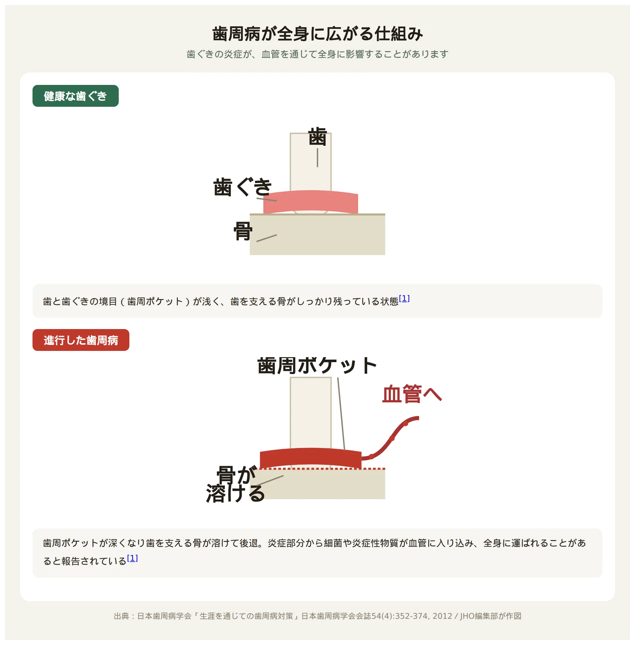 歯周病が進行すると歯周ポケットが深くなり、歯を支える骨が溶けて後退し、細菌や炎症物質が血管に入り込む仕組みを示す図