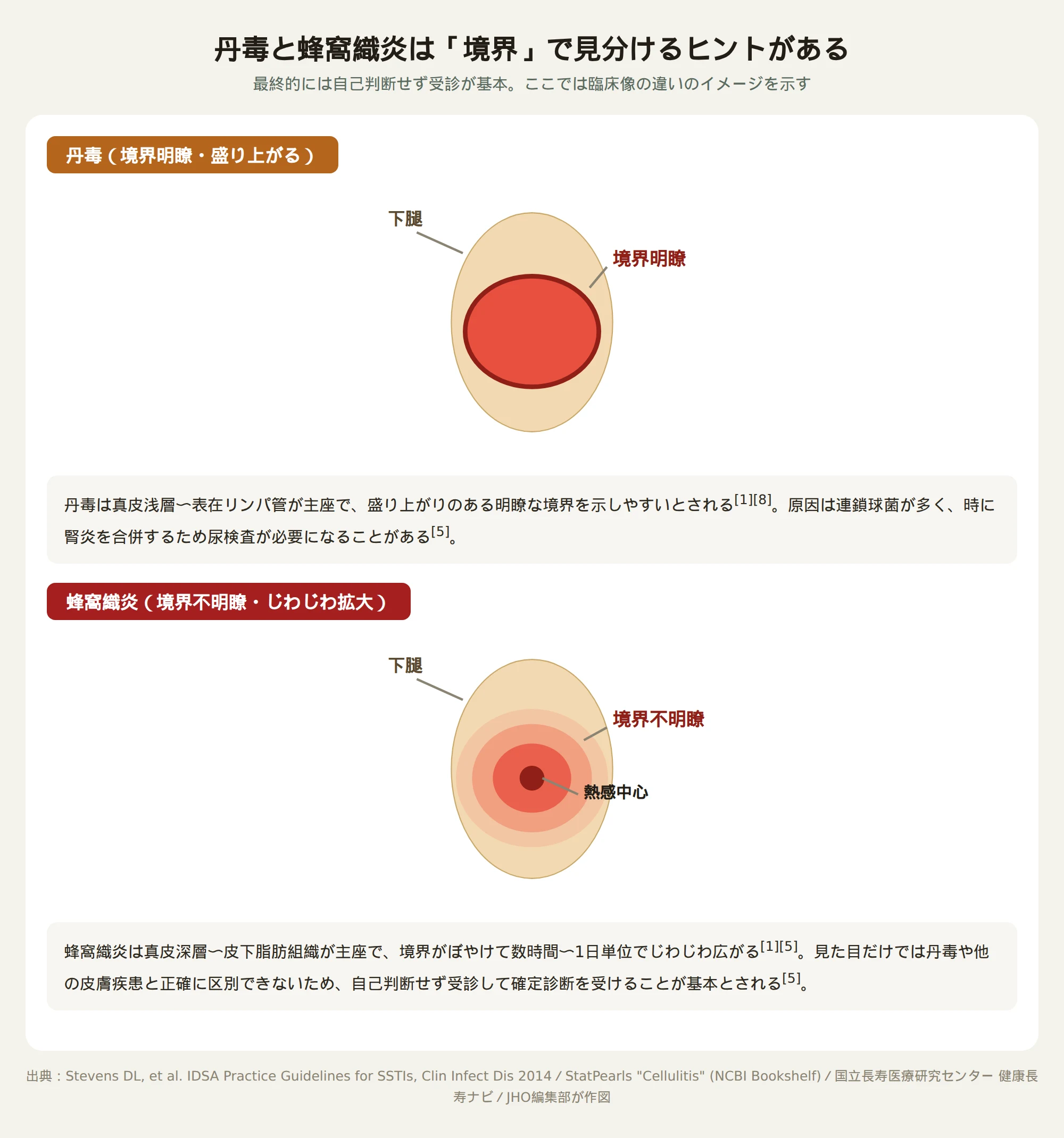 下腿のイラストを使い、丹毒は境界明瞭で盛り上がった赤み、蜂窩織炎は境界不明瞭で中心から外側にぼやけて広がる赤みであることを示した比較図