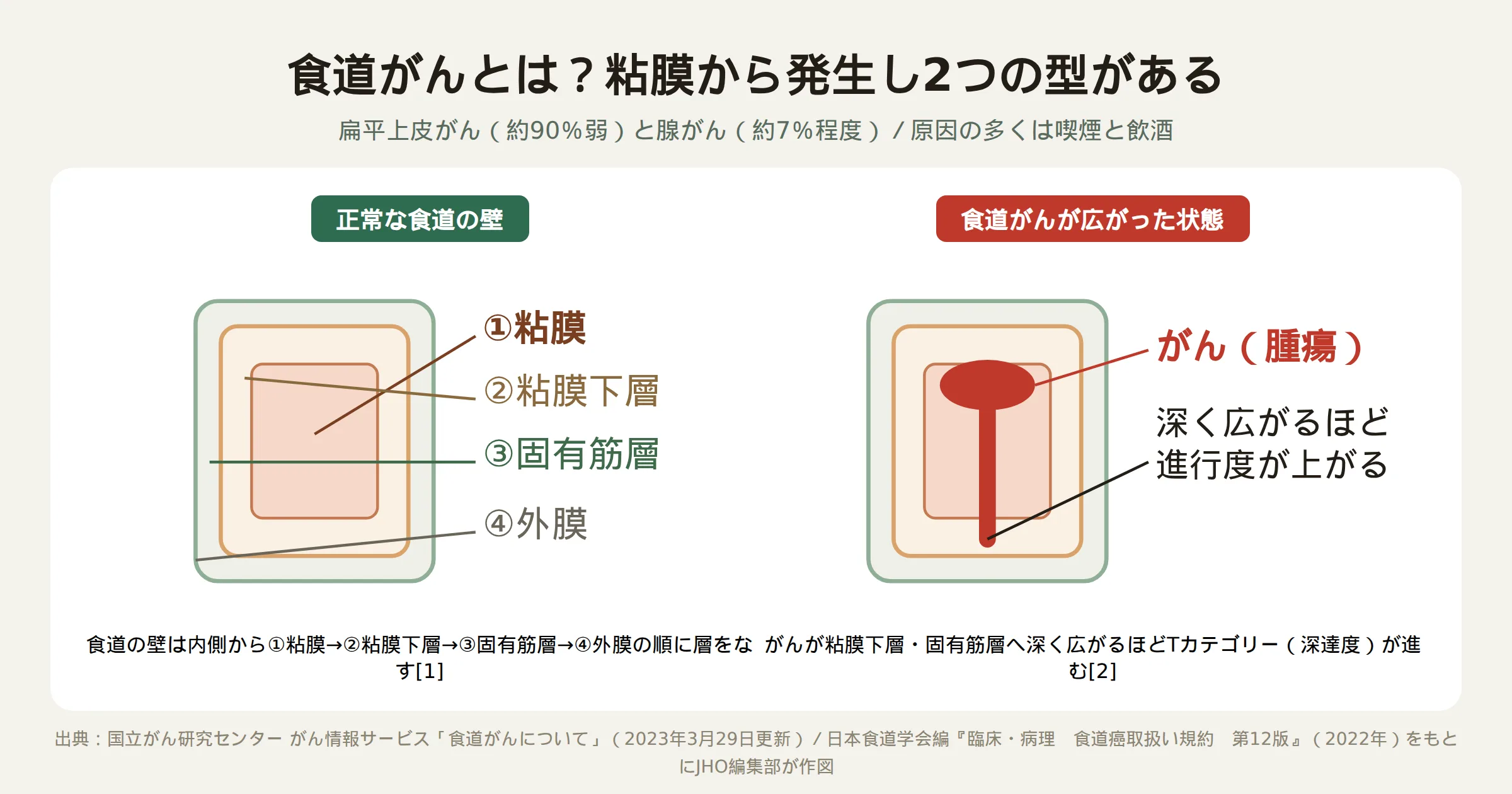 食道の壁の断面図。正常な食道は内側から粘膜・粘膜下層・固有筋層・外膜の順に層をなす。食道がんは粘膜表面から発生し、粘膜下層・固有筋層へ深く広がるほど進行度（Tカテゴリー）が上がる