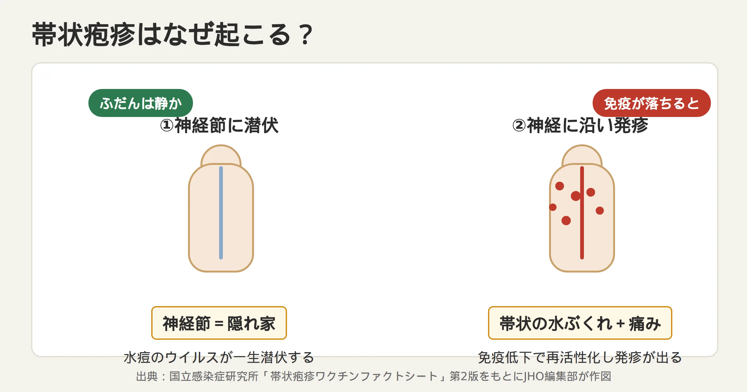 帯状疱疹の仕組み：水痘ウイルスが神経節に潜伏し、免疫低下で再活性化して神経に沿った発疹を起こす図解