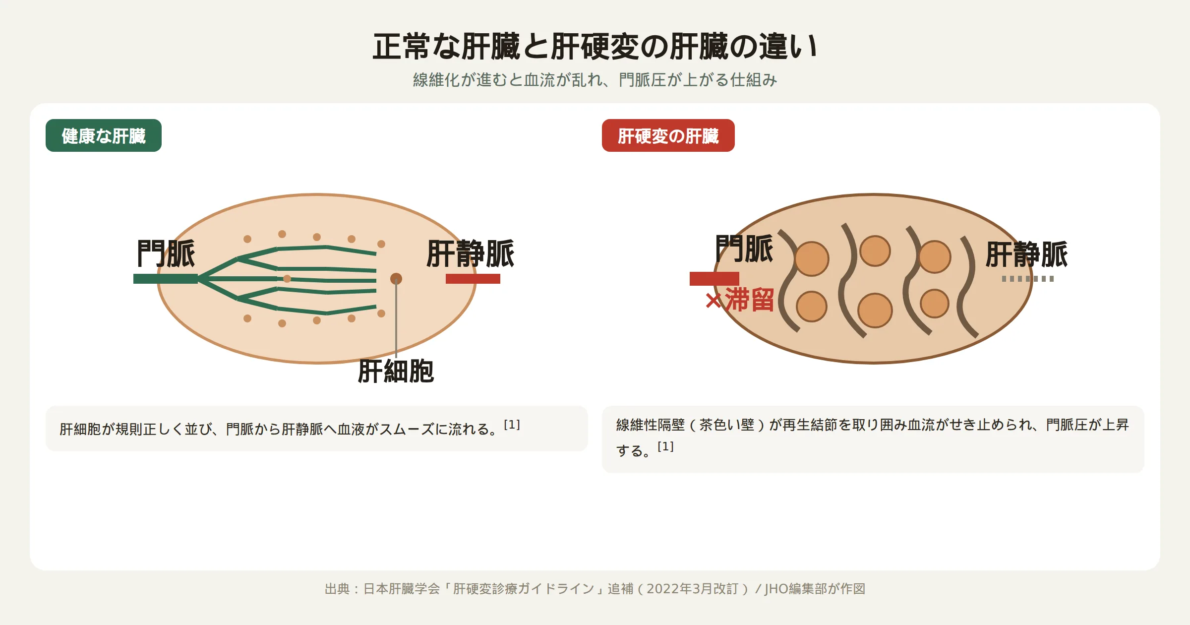 正常な肝臓と肝硬変の肝臓の構造の違いを示す図解：正常な肝臓は肝細胞が規則正しく並び血流がスムーズだが、肝硬変の肝臓は線維性隔壁が再生結節を取り囲み血流がせき止められ門脈圧が上昇する