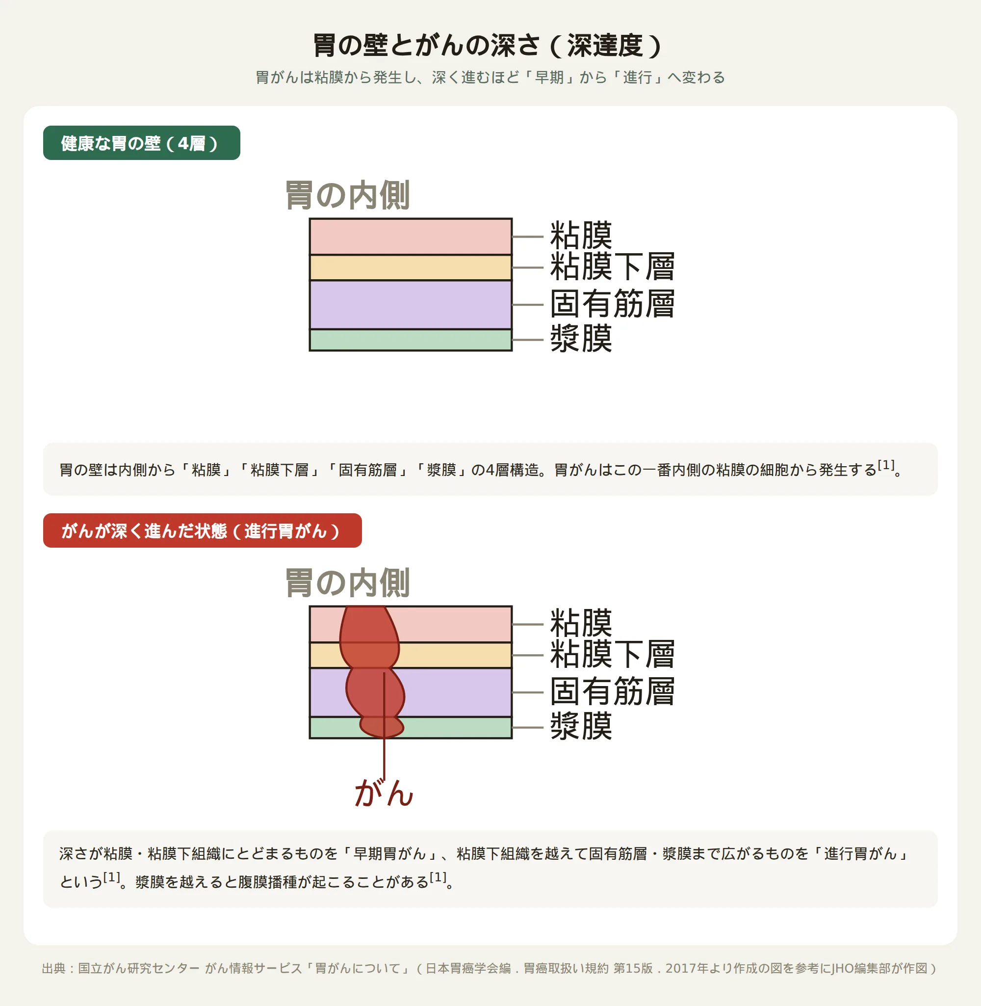 胃の壁の4層構造と胃がんの深達度（早期胃がんと進行胃がんの違い）