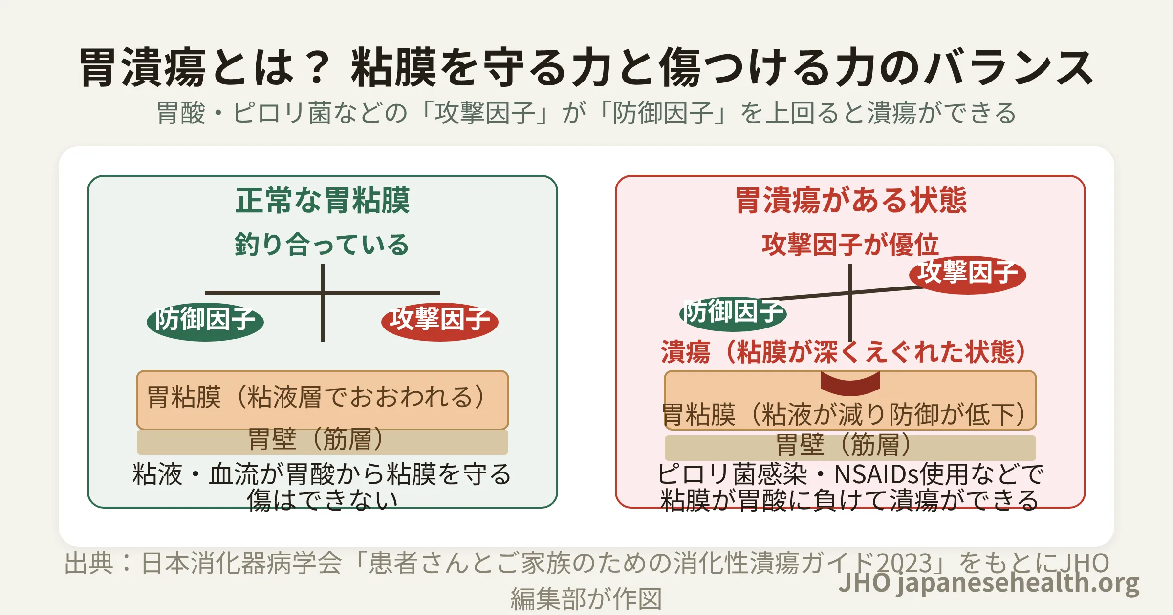 胃潰瘍の仕組みを示す図。正常な胃粘膜では防御因子と攻撃因子が釣り合っているが、ピロリ菌感染やNSAIDs使用で攻撃因子が優位になると粘膜が深くえぐれて潰瘍ができる過程を左右比較で表す