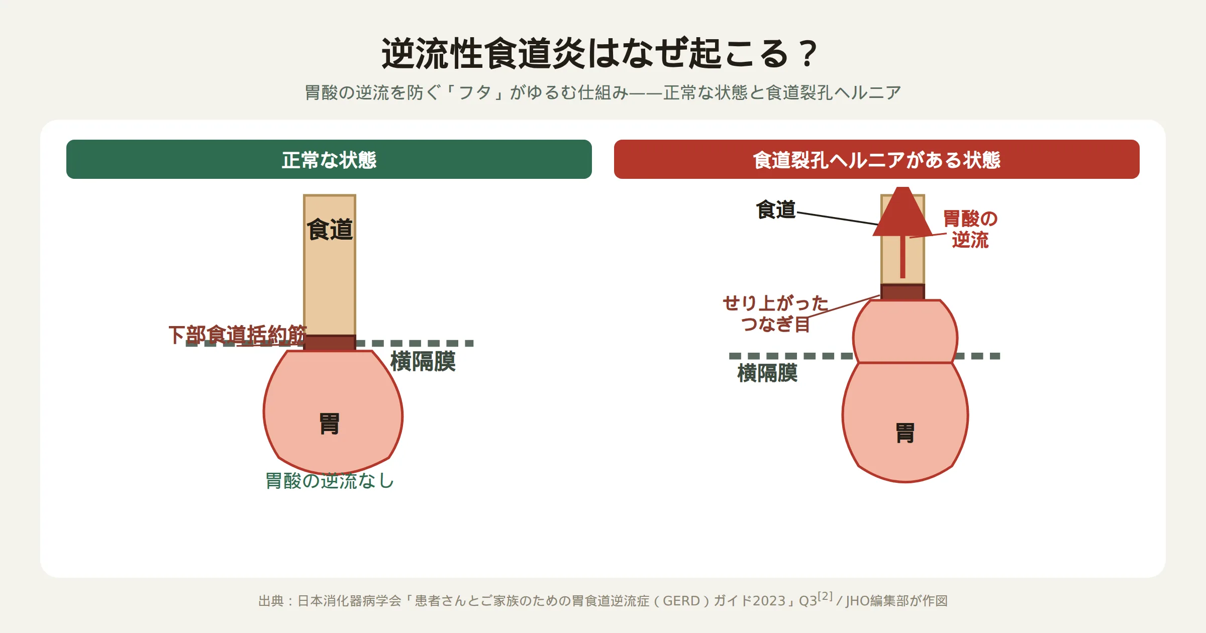 逆流性食道炎が起こる仕組み——正常な状態と食道裂孔ヘルニアの比較図