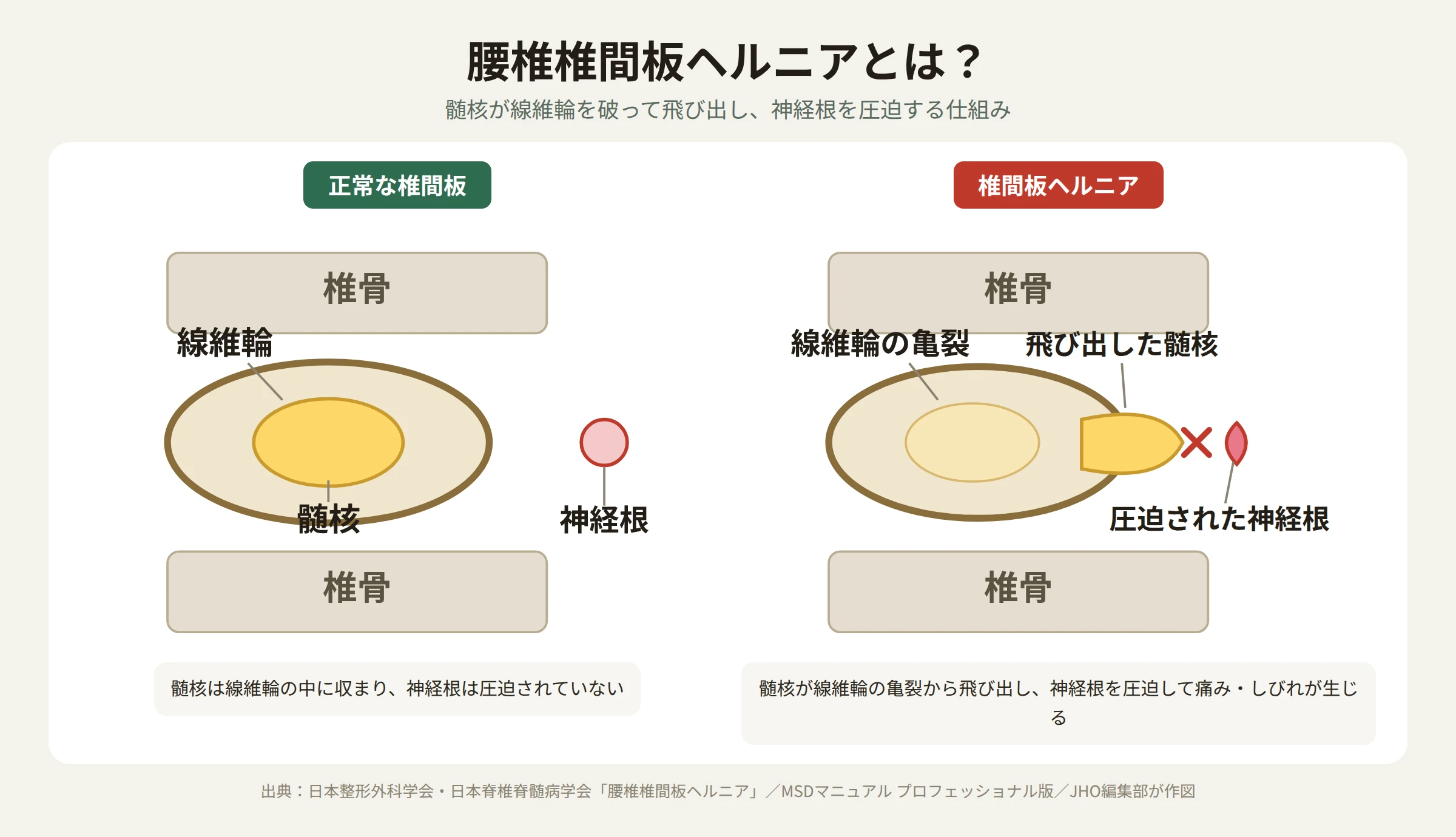 正常な椎間板と、髄核が線維輪を突き破って神経根を圧迫する腰椎椎間板ヘルニアの断面比較図