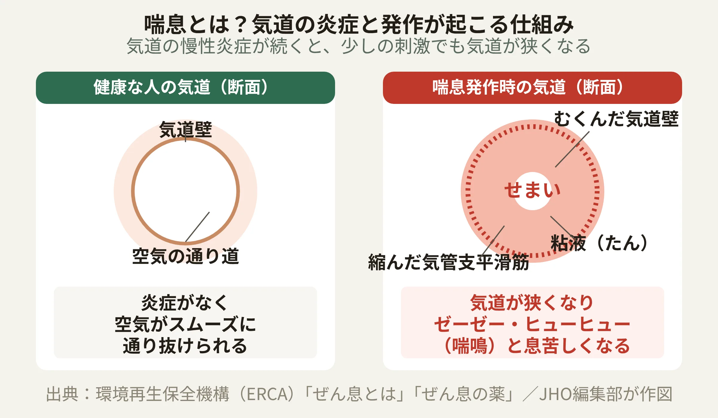 喘息とは？気道の炎症と発作が起こる仕組み