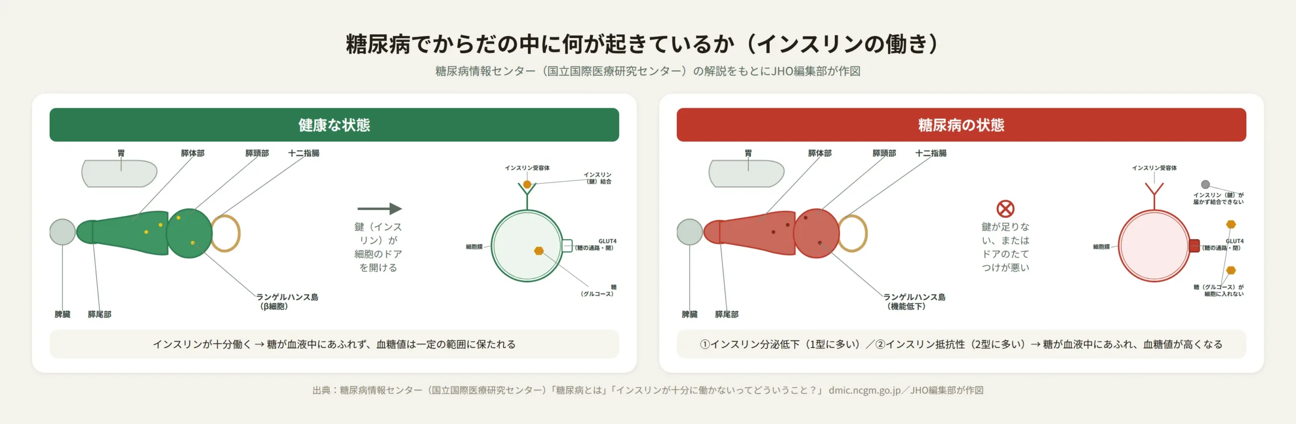 糖尿病でインスリンの働きが低下する仕組み（膵頭部・膵体部・膵尾部と十二指腸・脾臓の位置関係、細胞のインスリン受容体とGLUT4の図解）