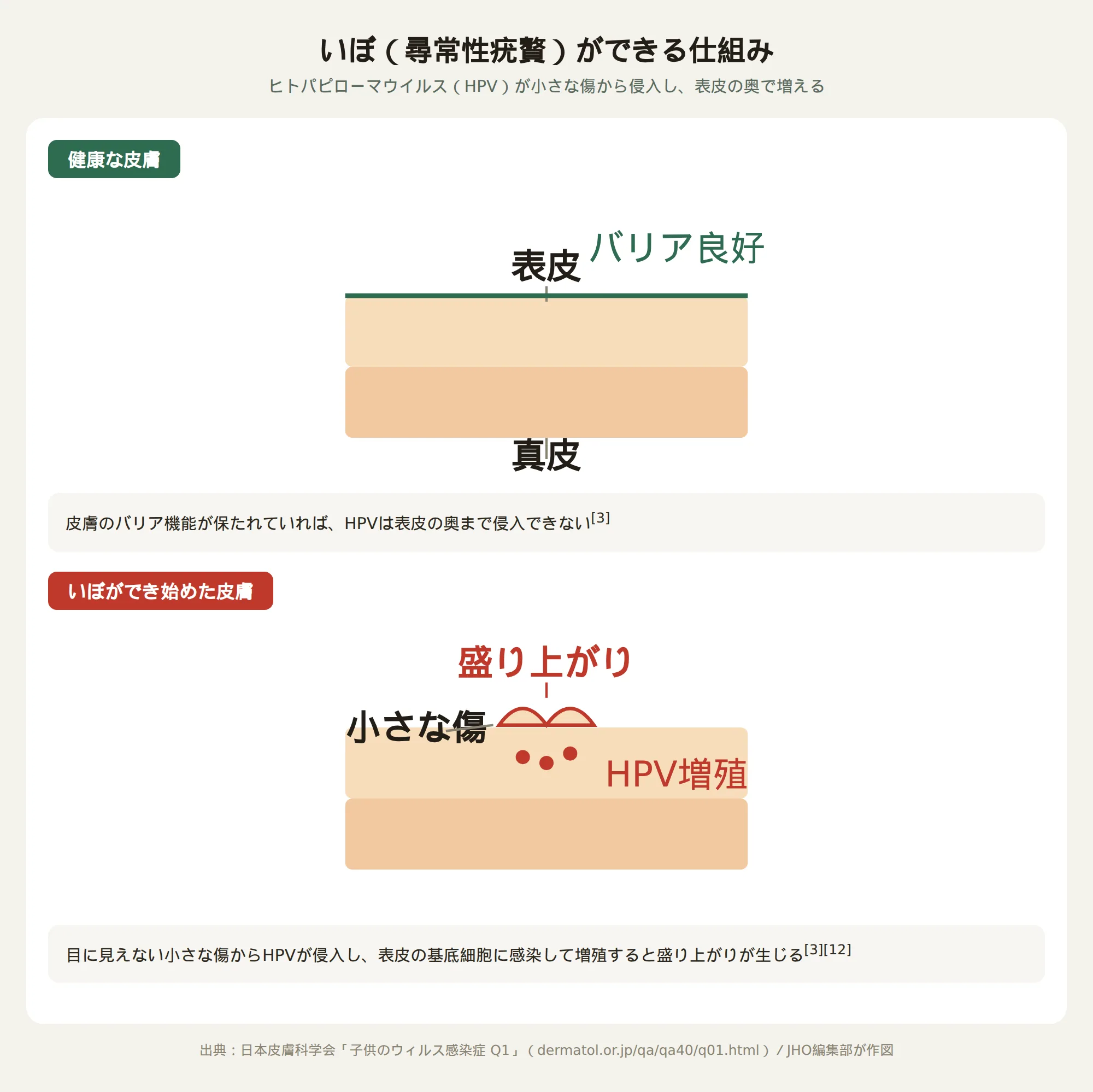 いぼ（尋常性疣贅）ができる仕組み：健康な皮膚とHPV感染で盛り上がりが生じる皮膚の説明図