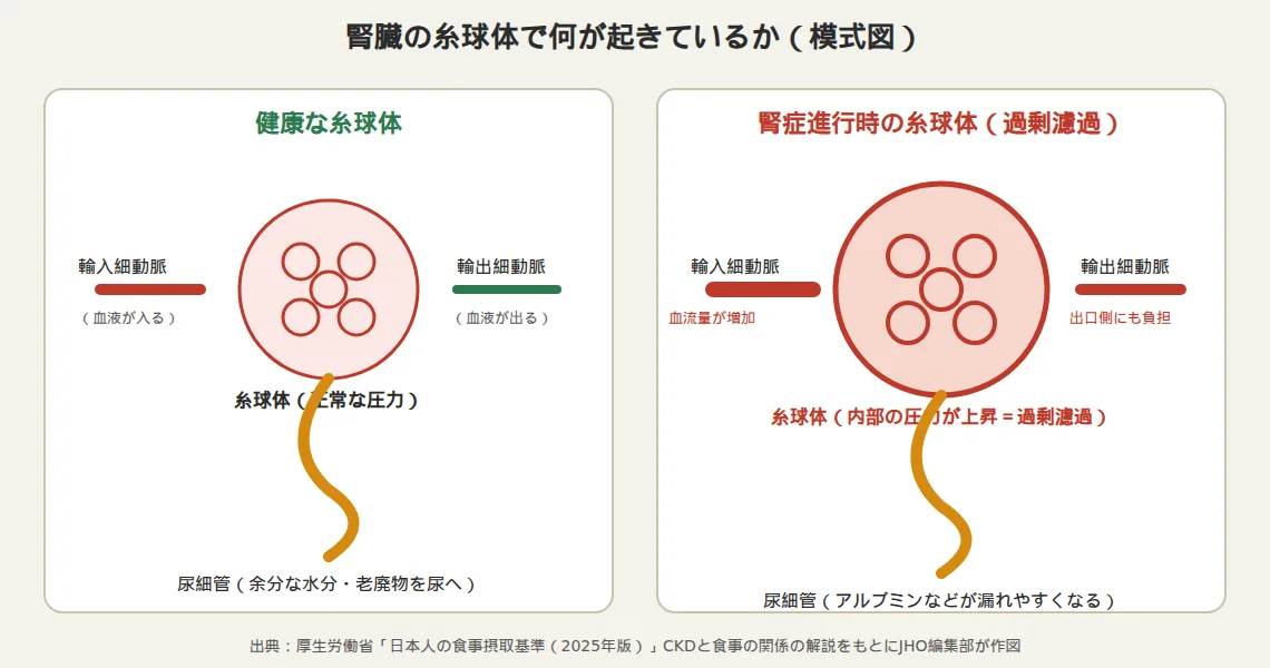 腎臓の糸球体の模式図。健康な糸球体では輸入細動脈から血液が入り輸出細動脈から出て正常な圧力が保たれるが、腎症進行時は血流量増加により糸球体内部の圧力が上昇（過剰濾過）し、尿細管からアルブミンなどが漏れやすくなることを示す図