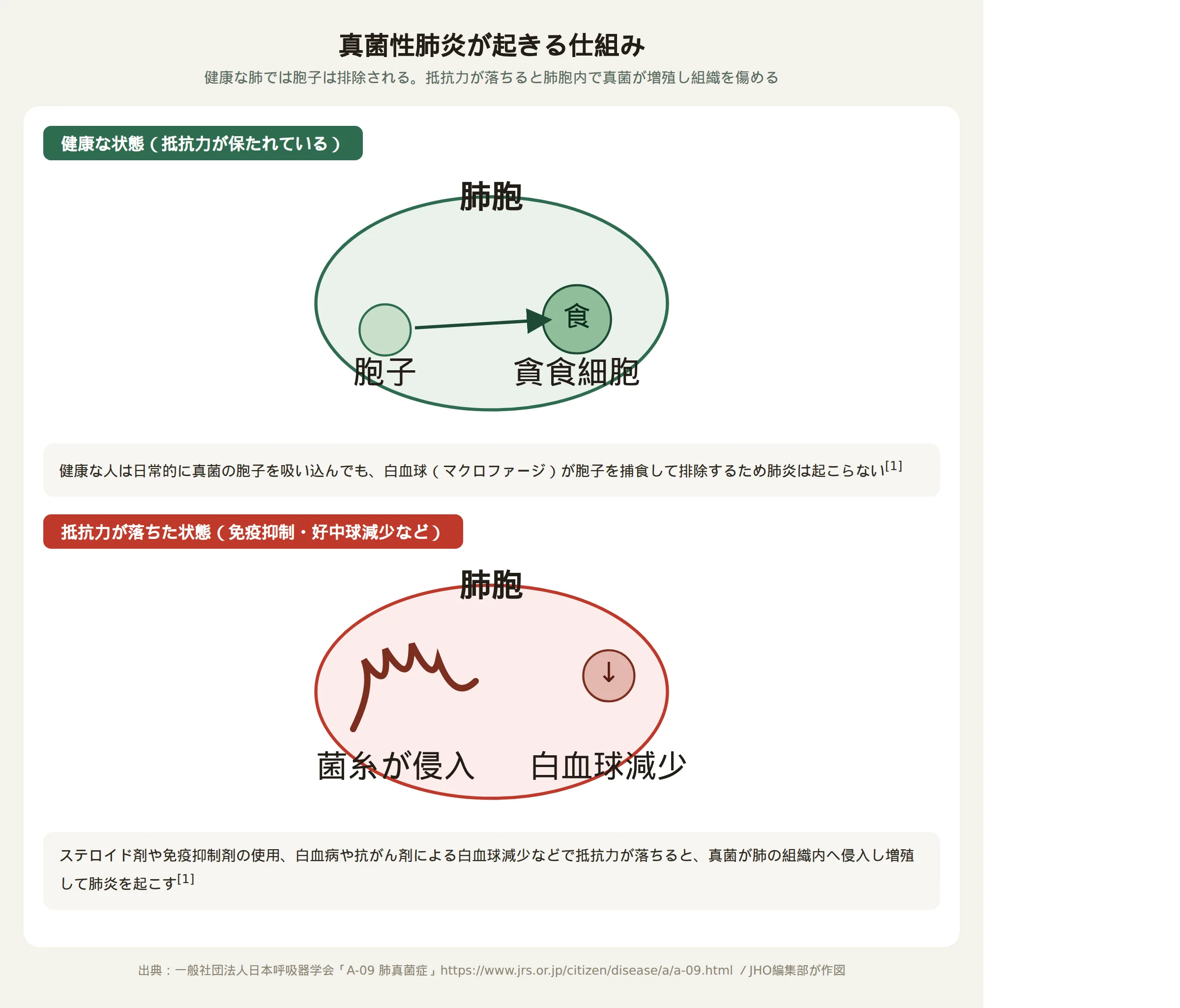 真菌性肺炎の主な原因菌と発症の仕組み