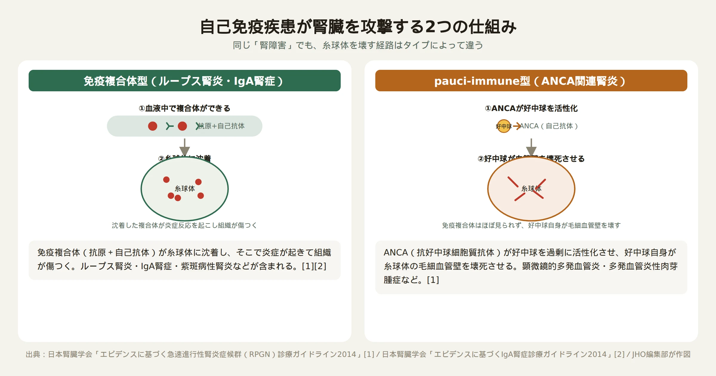 自己免疫疾患が腎臓を攻撃する2つの仕組み、免疫複合体型とANCA自己抗体型の図解