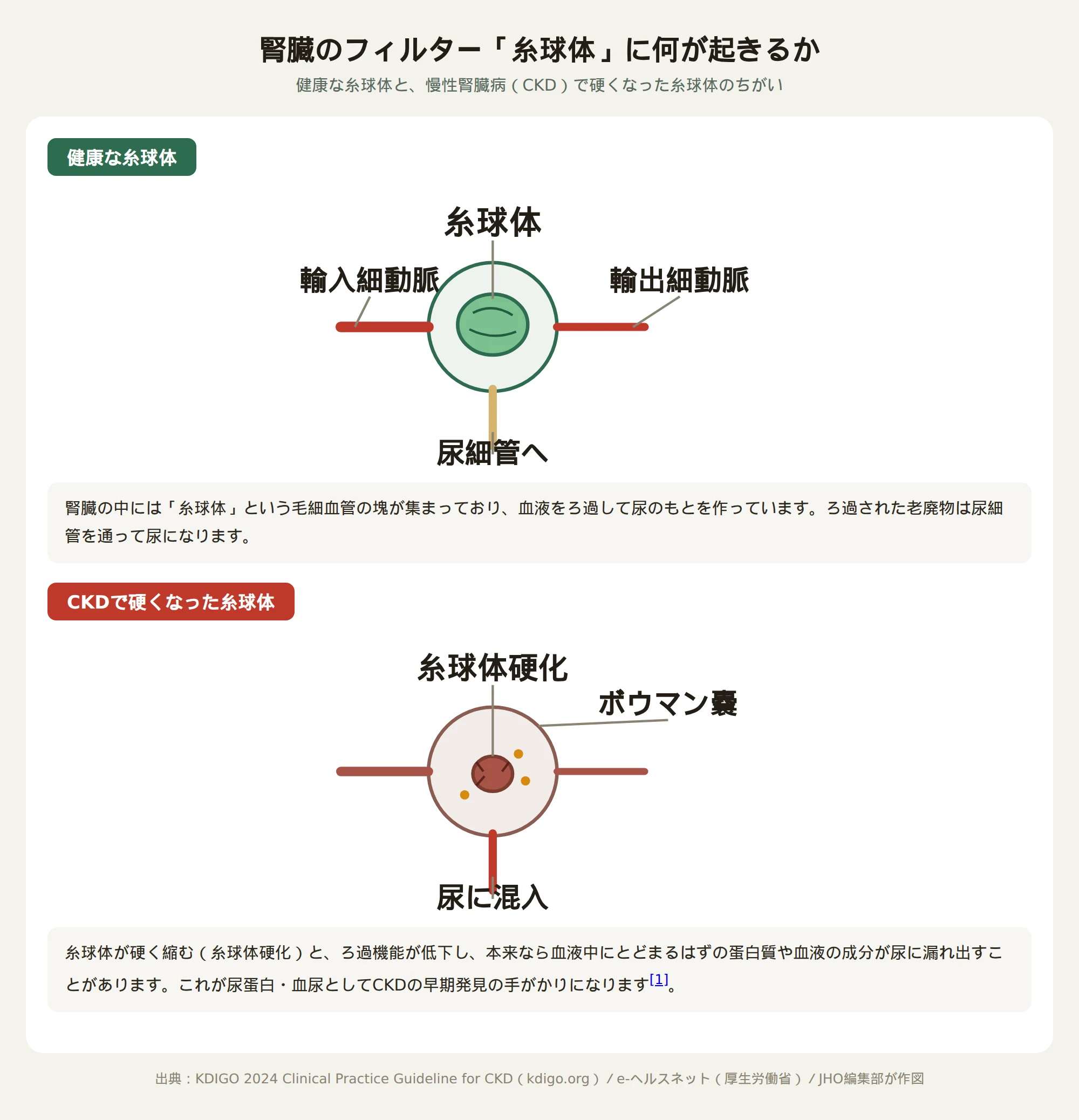 腎臓のフィルター「糸球体」の比較図。健康な糸球体は毛細血管の塊がろ過機能を保っているが、CKDで硬くなった糸球体（糸球体硬化）はろ過機能が低下し、蛋白質や血液成分が尿に漏れ出す。血液は輸入細動脈から入り輸出細動脈へ出て、ろ過された老廃物は尿細管へ、漏れ出した成分はボウマン嚢を経て尿に混入する