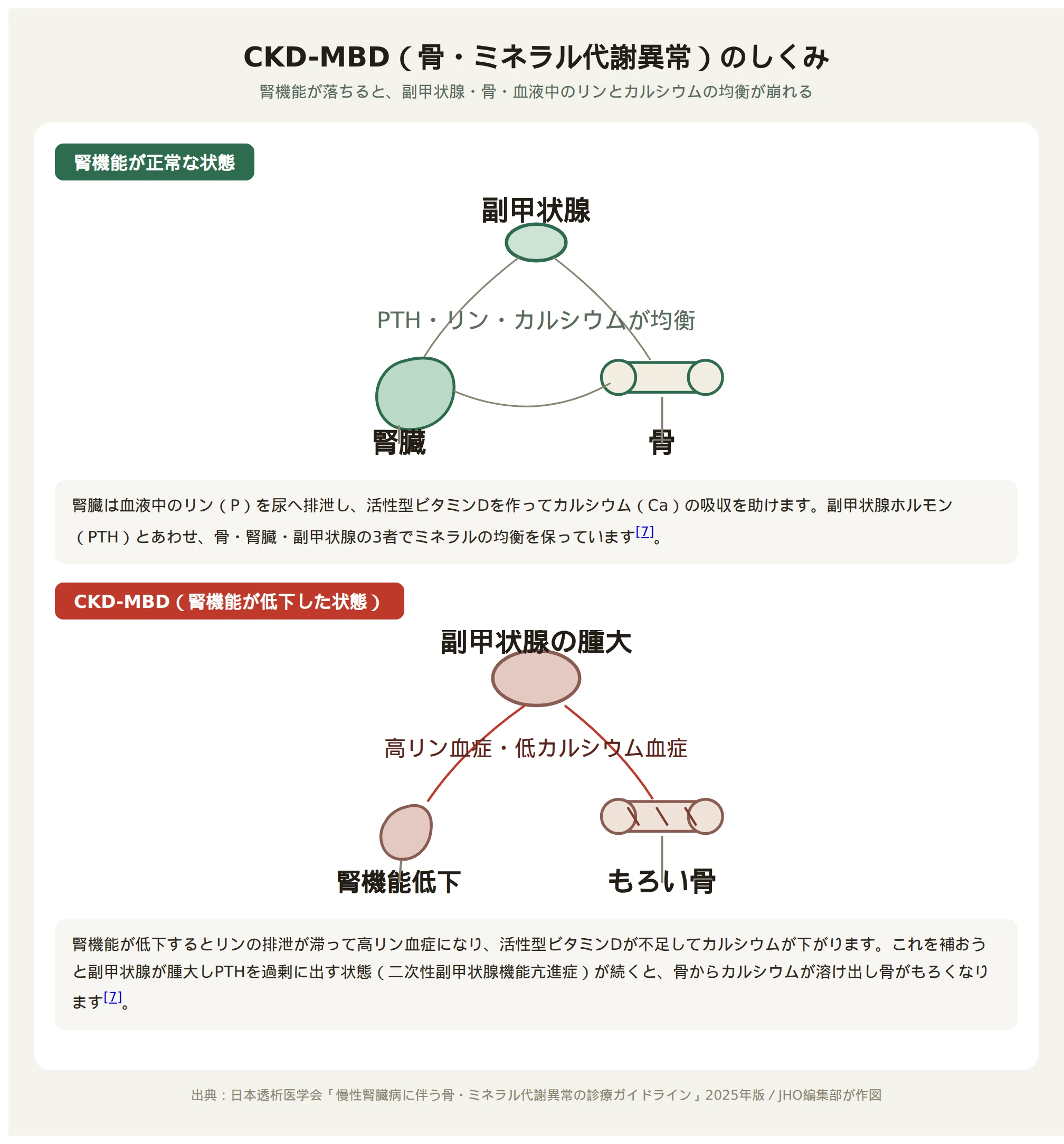 CKD-MBDのしくみを示す図。腎機能が正常なときは副甲状腺・腎臓・骨の間でリン・カルシウムの均衡が保たれているが、腎機能が低下すると副甲状腺が腫大してリンが体に貯留し、骨からカルシウムが溶け出してもろくなる
