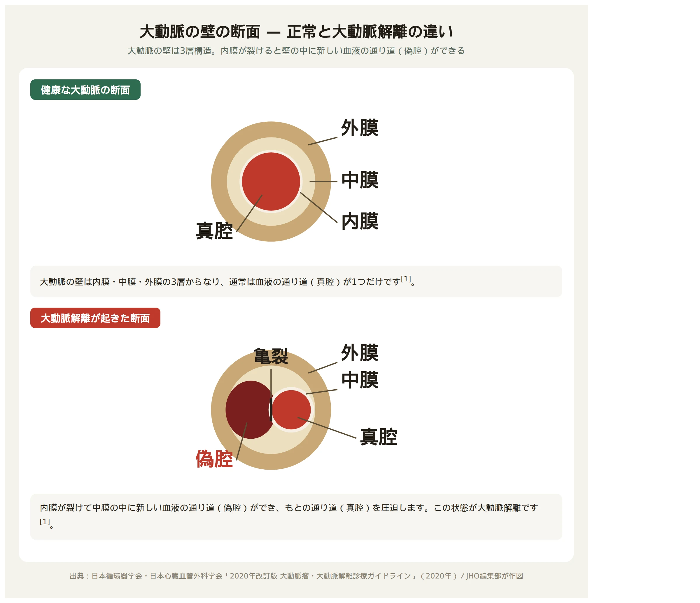 大動脈の壁の断面図。健康な状態では内膜・中膜・外膜の3層に囲まれた真腔が1つだけあるが、大動脈解離が起きると内膜が裂けて中膜の中に偽腔ができ、真腔を圧迫する