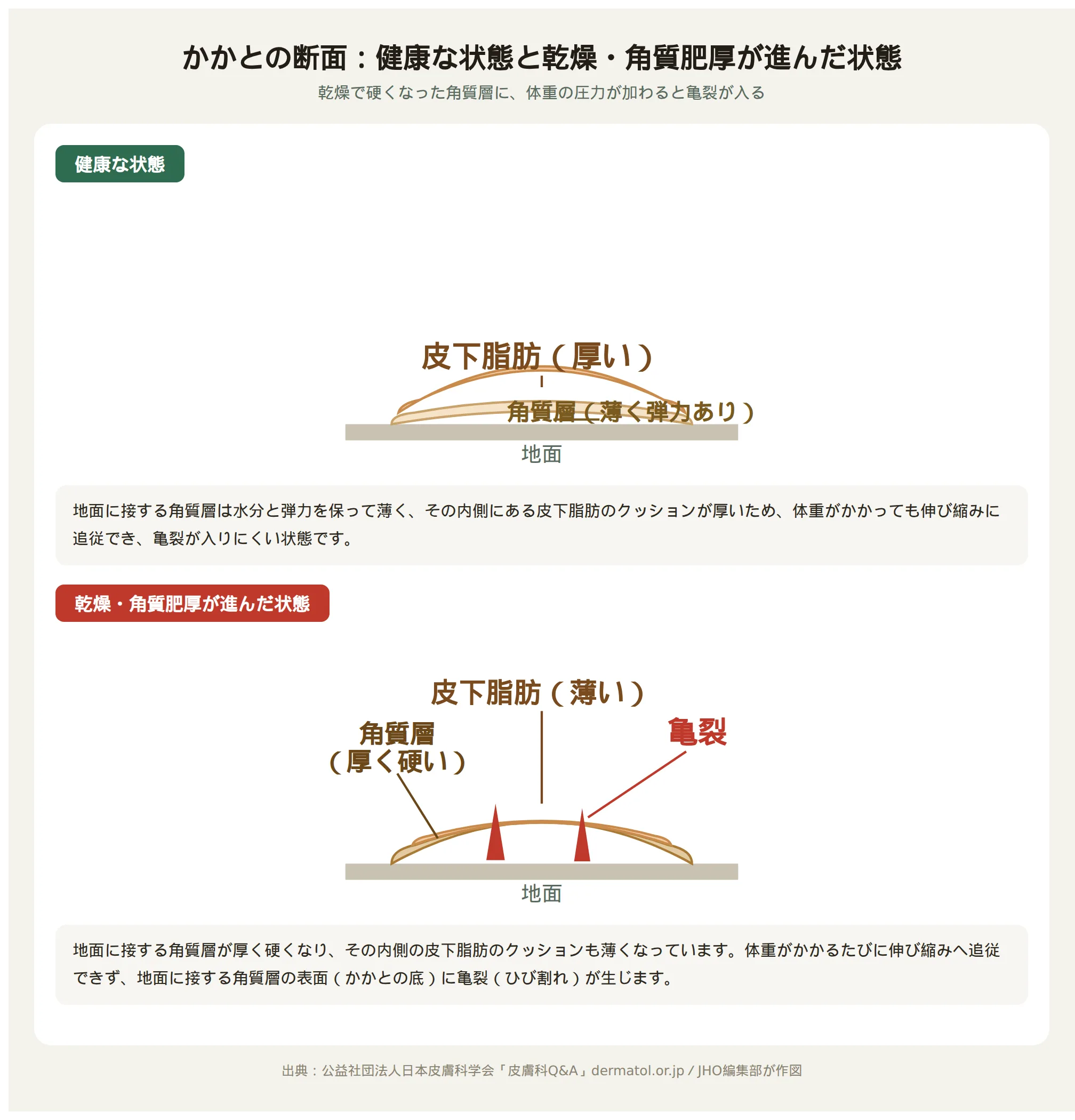 健康なかかとと乾燥・角質肥厚が進んだかかとの断面比較図。角質層と皮下脂肪の厚みの違いと亀裂の位置を示す