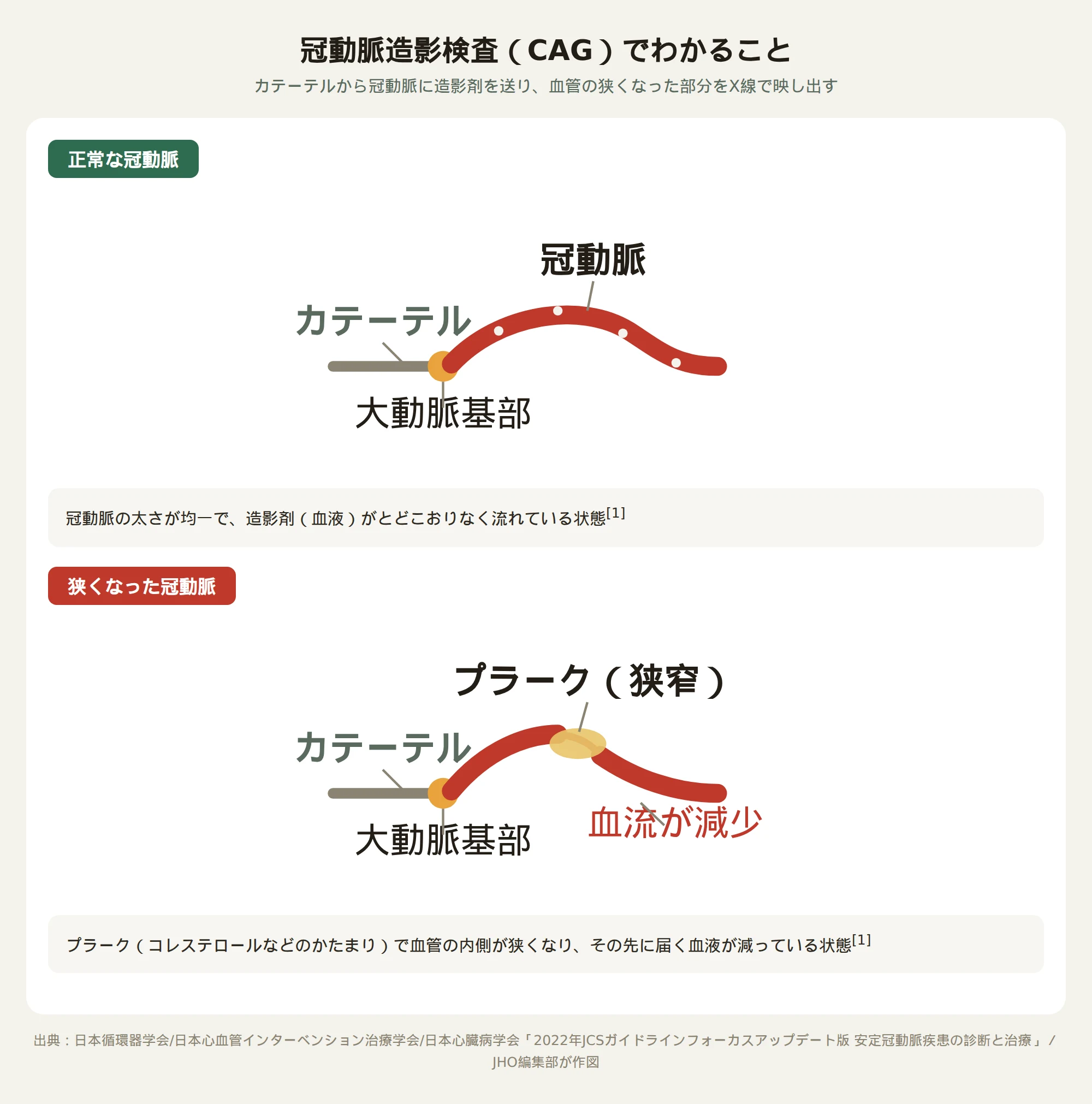 冠動脈造影検査でカテーテルから造影剤を送り、狭くなった冠動脈を映し出す仕組みの図