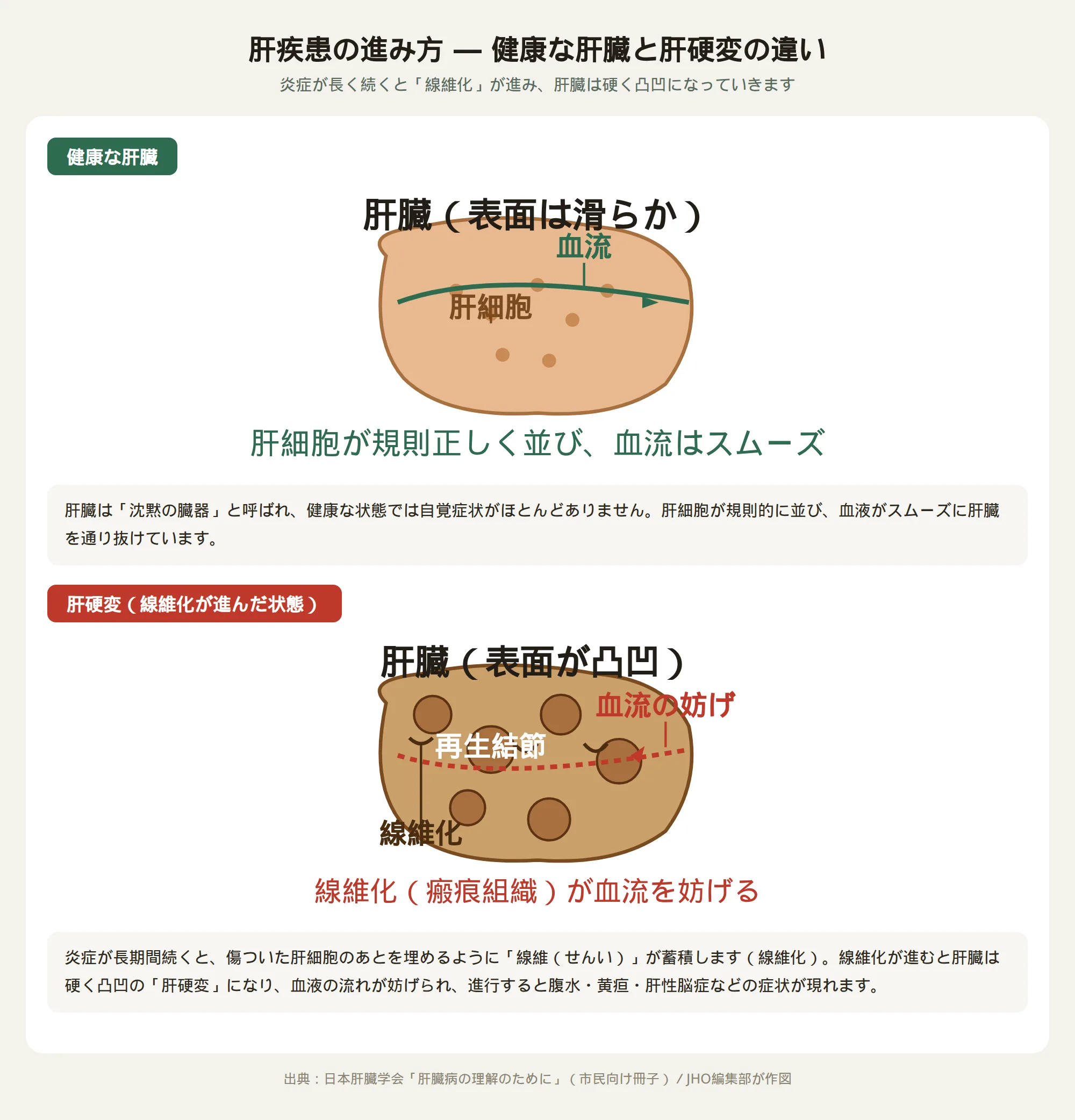 肝疾患の進み方を示すイラスト。健康な肝臓は滑らかで肝細胞が規則正しく並び血流もスムーズだが、肝硬変になると凸凹になり線維化した瘢痕組織が血流を妨げる様子を描いている