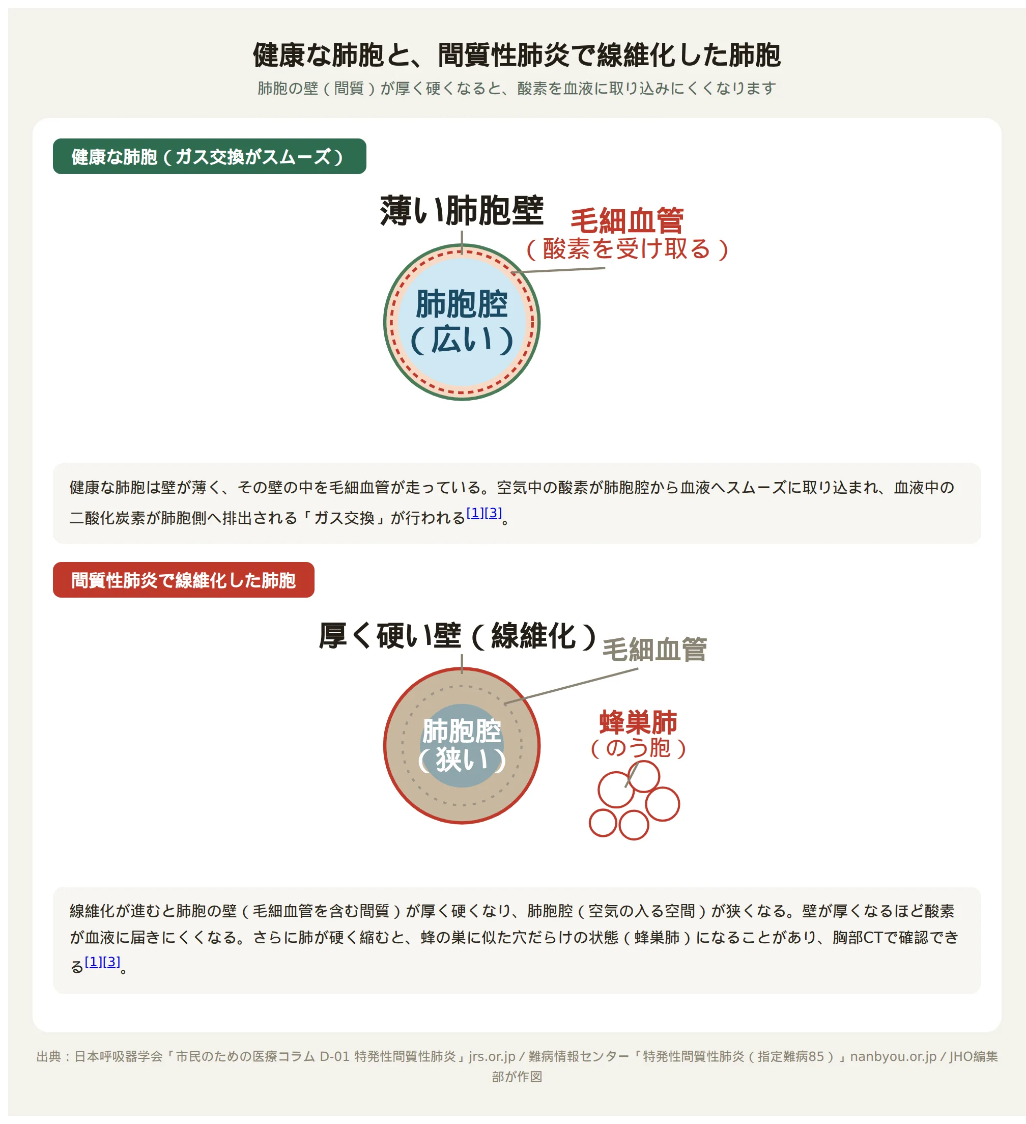 健康な肺胞と間質性肺炎で線維化した肺胞の比較図。健康な肺胞は壁が薄くガス交換がスムーズだが、間質性肺炎で線維化した肺胞は壁が厚く硬くなり肺胞腔が狭くなり、蜂の巣状の穴（蜂巣肺）ができることもある