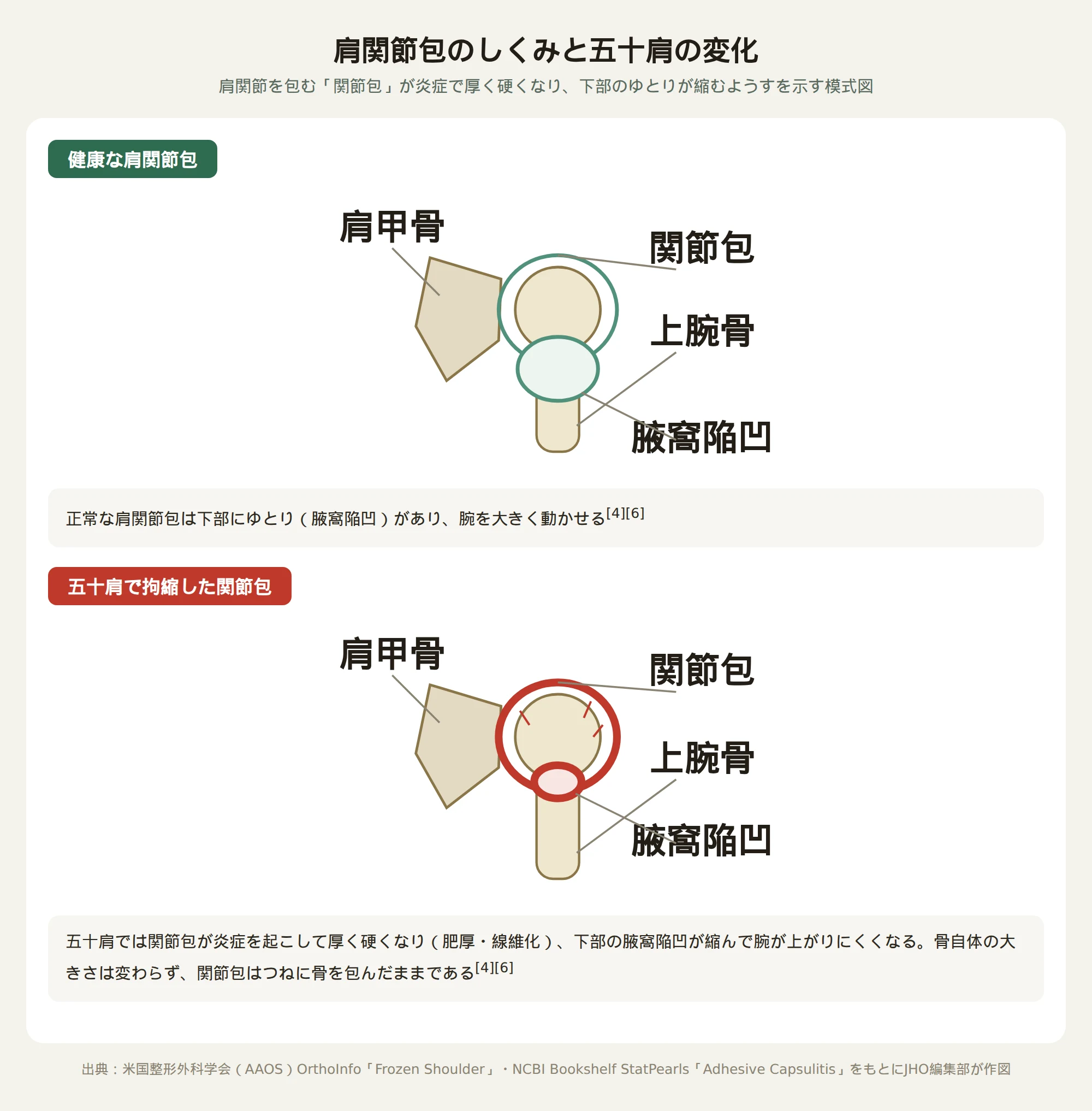 健康な肩関節包と、五十肩で炎症を起こして厚く硬くなった関節包を並べて示す模式図。上腕骨頭・肩甲骨・関節包・腋窩陥凹（関節包下部のゆとり）にそれぞれ名称を付し、拘縮した状態では関節包が厚く赤く縁取られ、下部のゆとりが縮んでいることを示す