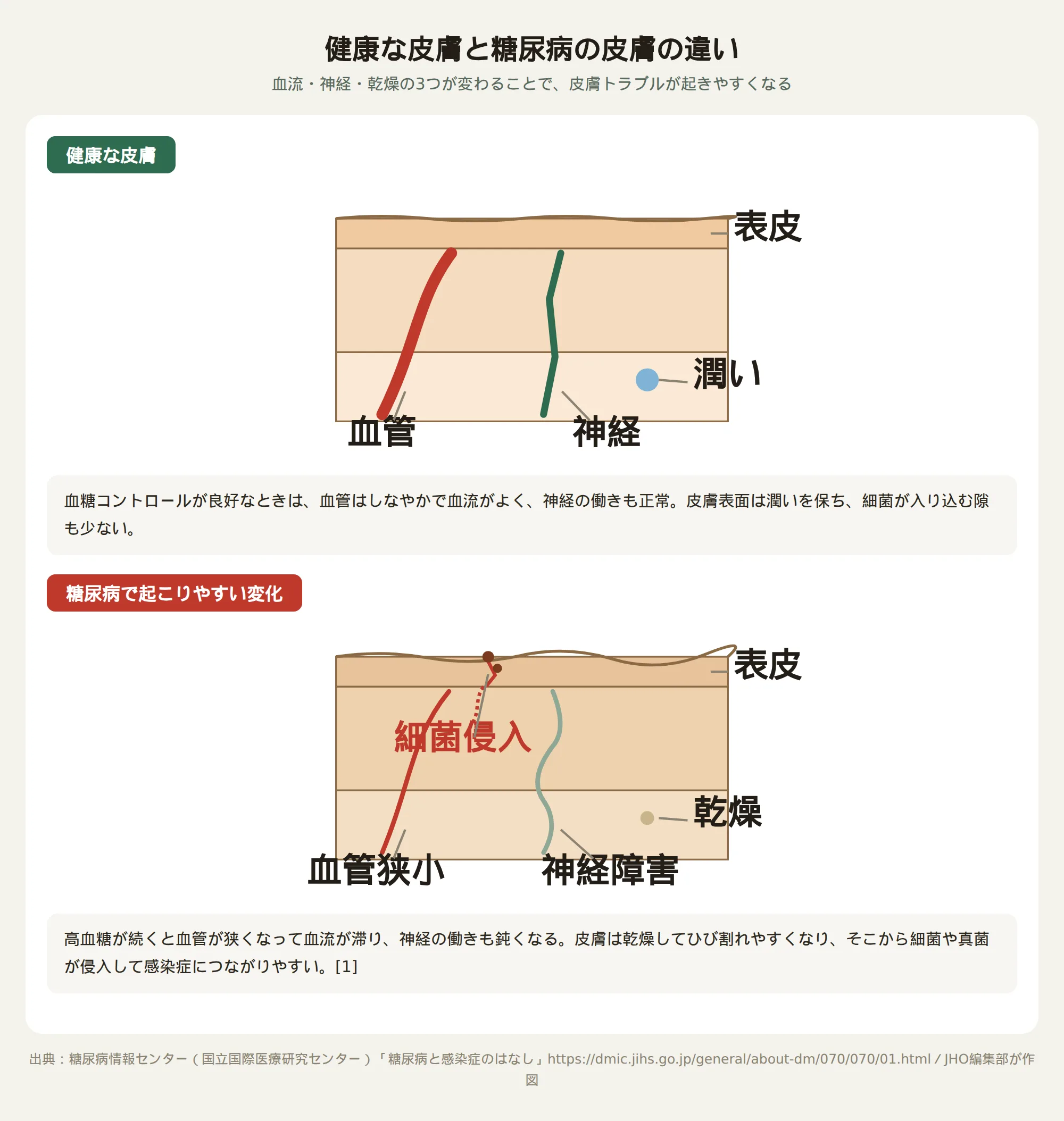健康な皮膚と糖尿病の皮膚の違いを示す断面図。血管の狭さ・神経障害・乾燥の違いを図で説明