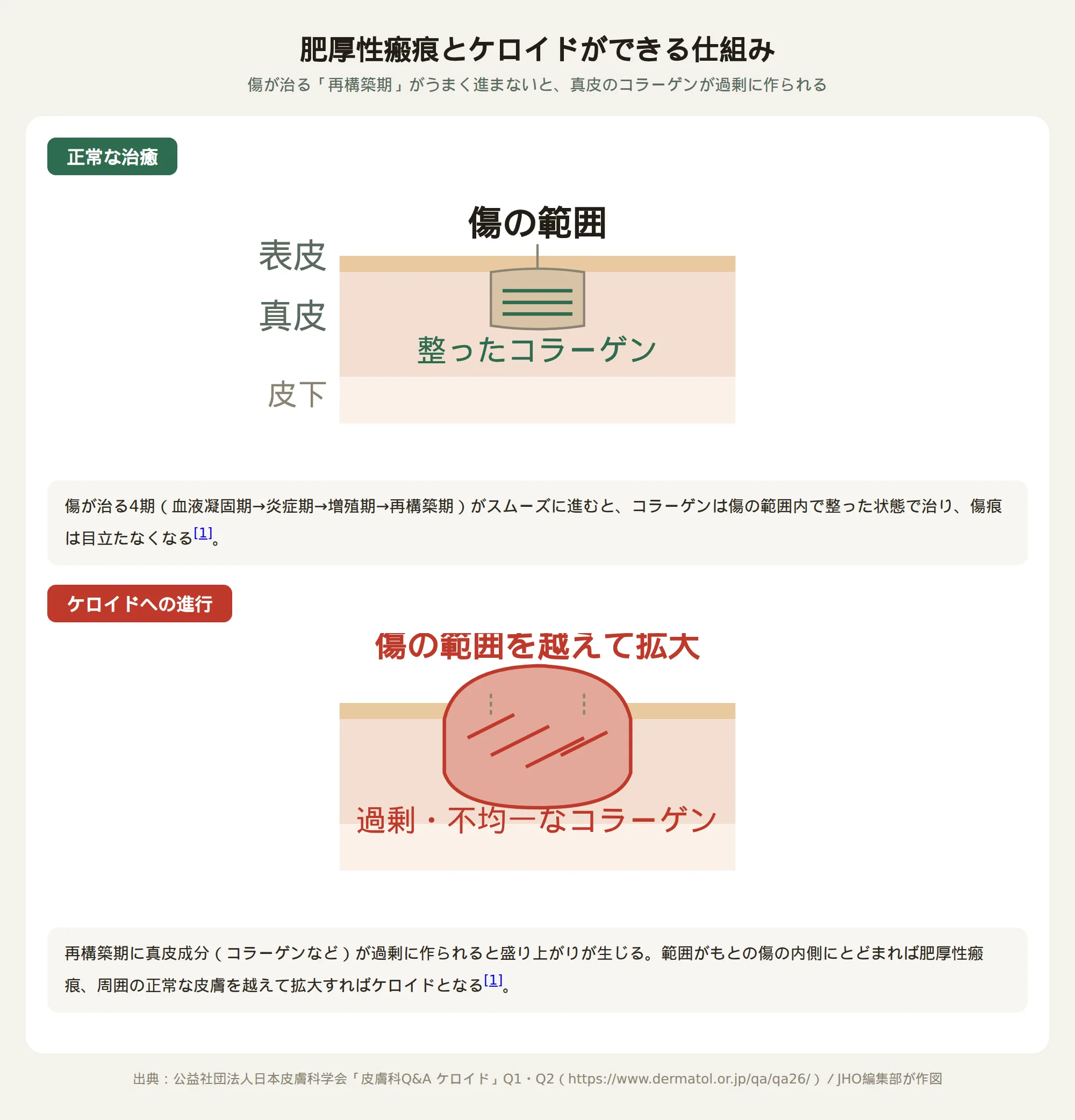 肥厚性瘢痕とケロイドができる仕組みを示した皮膚断面図。正常な治癒ではコラーゲンが傷の範囲内で整うが、ケロイドでは範囲を越えて過剰・不均一なコラーゲンが広がる